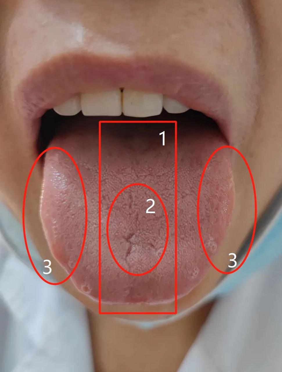 像这一位病友,舌象是典型的中焦虚寒湿,肝血不足的舌像 标记1:舌中