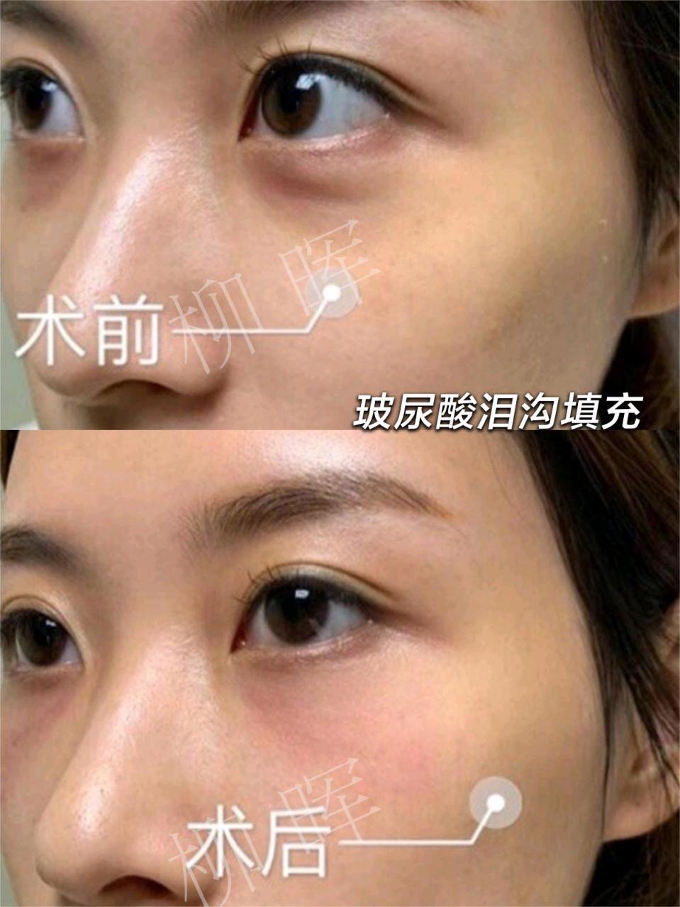胶原蛋白填充泪沟维持多久?真实案例带你了解胶原蛋白!