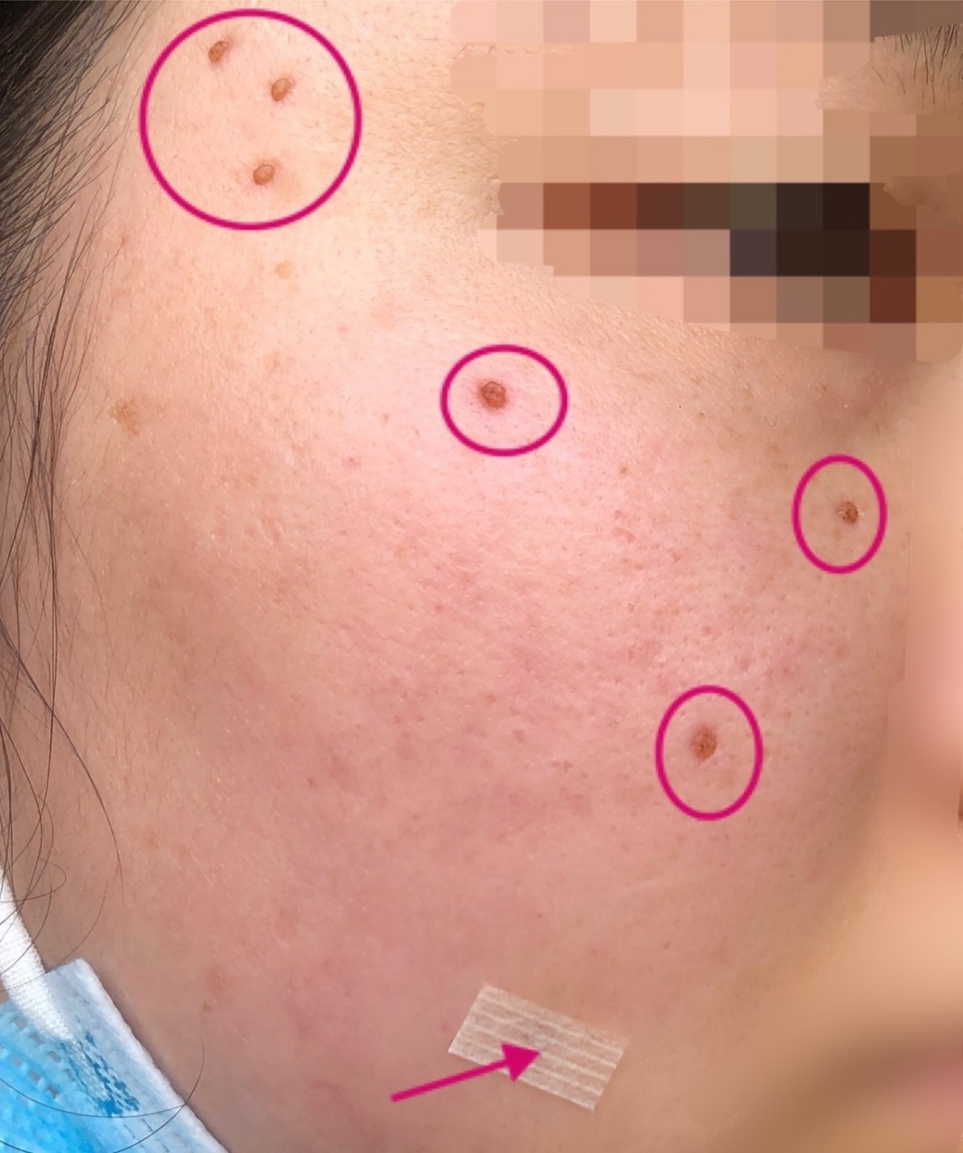 脸上的痣图片及全解  关于脸上的痣,一般人除想到是否美观外,还有就是