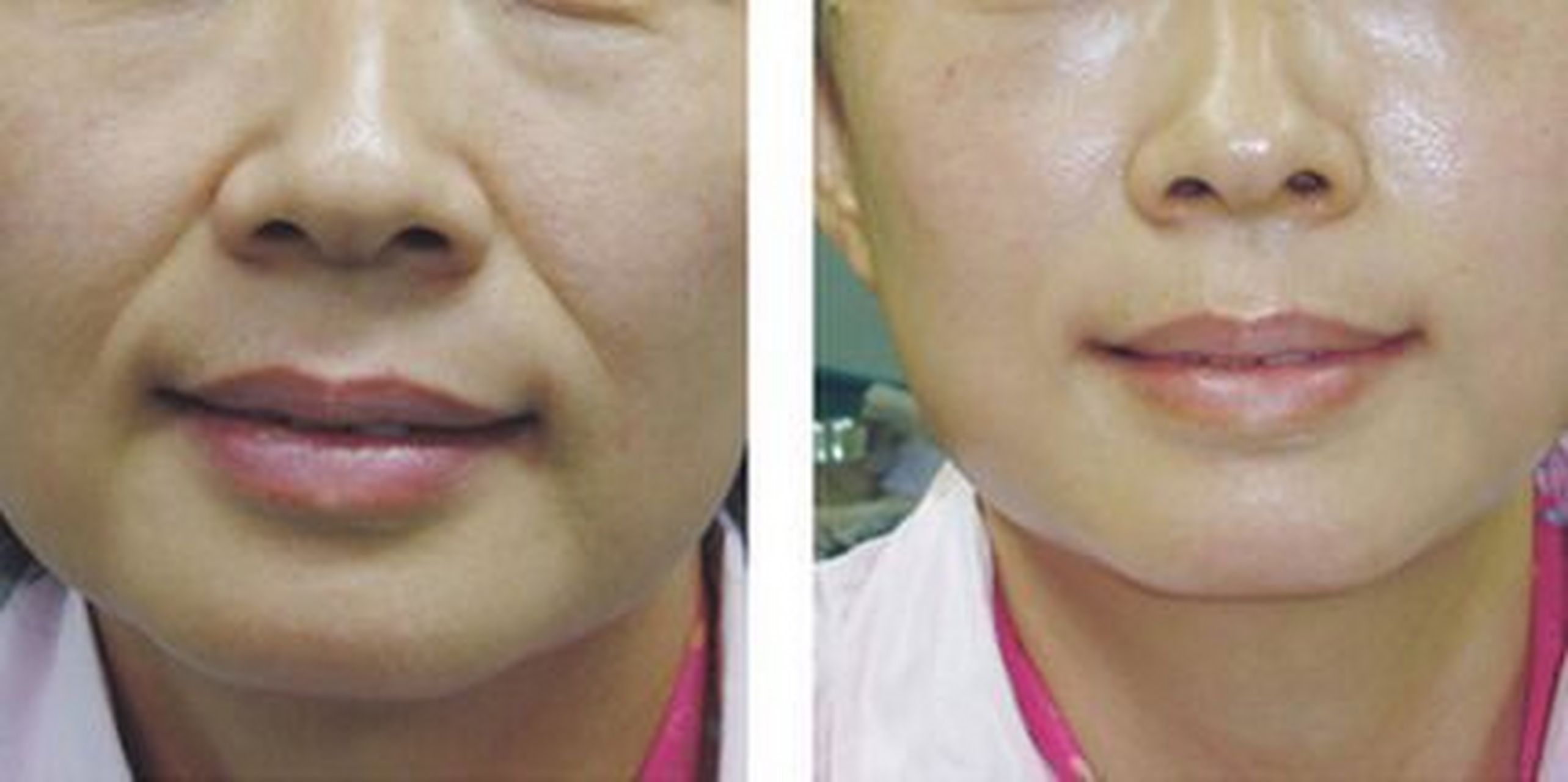 很多朋友鼻翼边缘出现法令纹,想着打几针除皱针就可以消除.