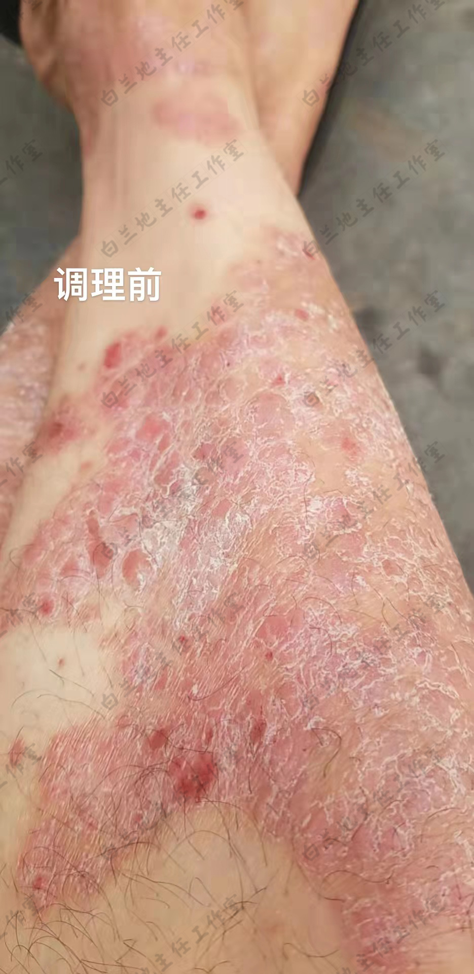 银屑病腿部图片银屑病全身牛皮癣腿部图片腿上银屑病图片腿部牛皮癣