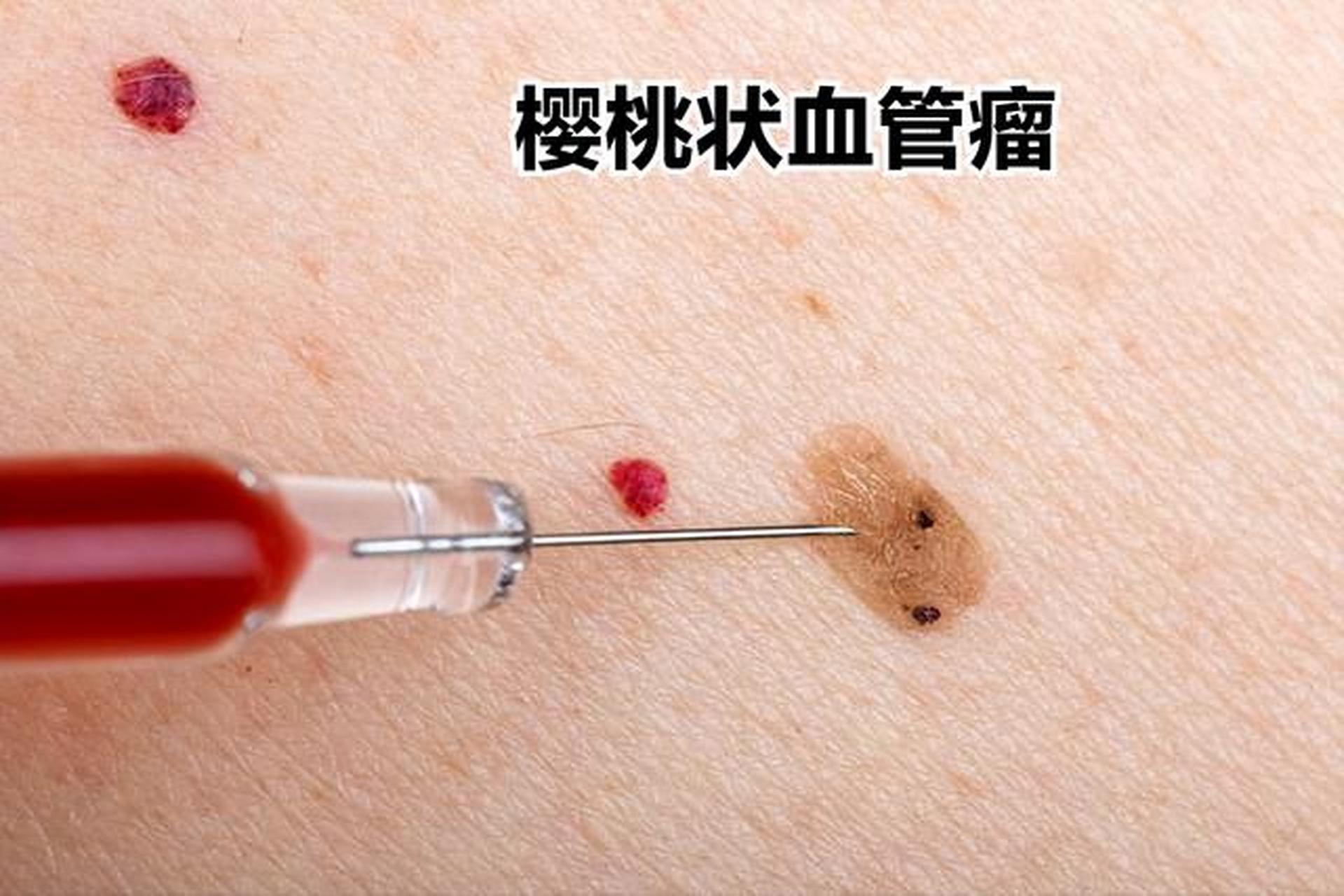 这种"血痣"学名叫"樱桃状血管瘤",很多人也叫它"老年性血管瘤"