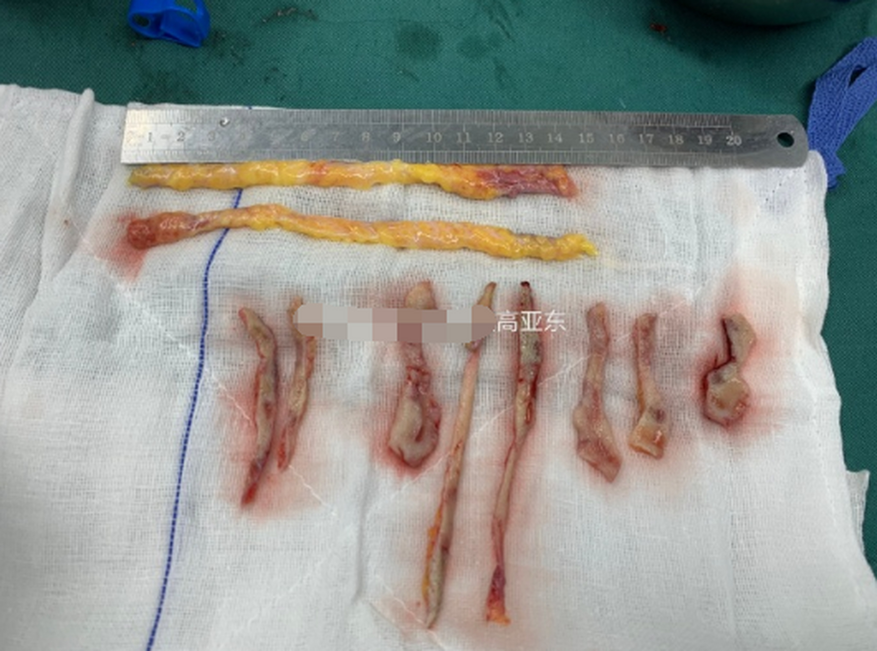 面部严重松弛下垂的顾客做大拉皮手术时需要切除的皮肤和筋膜量,给