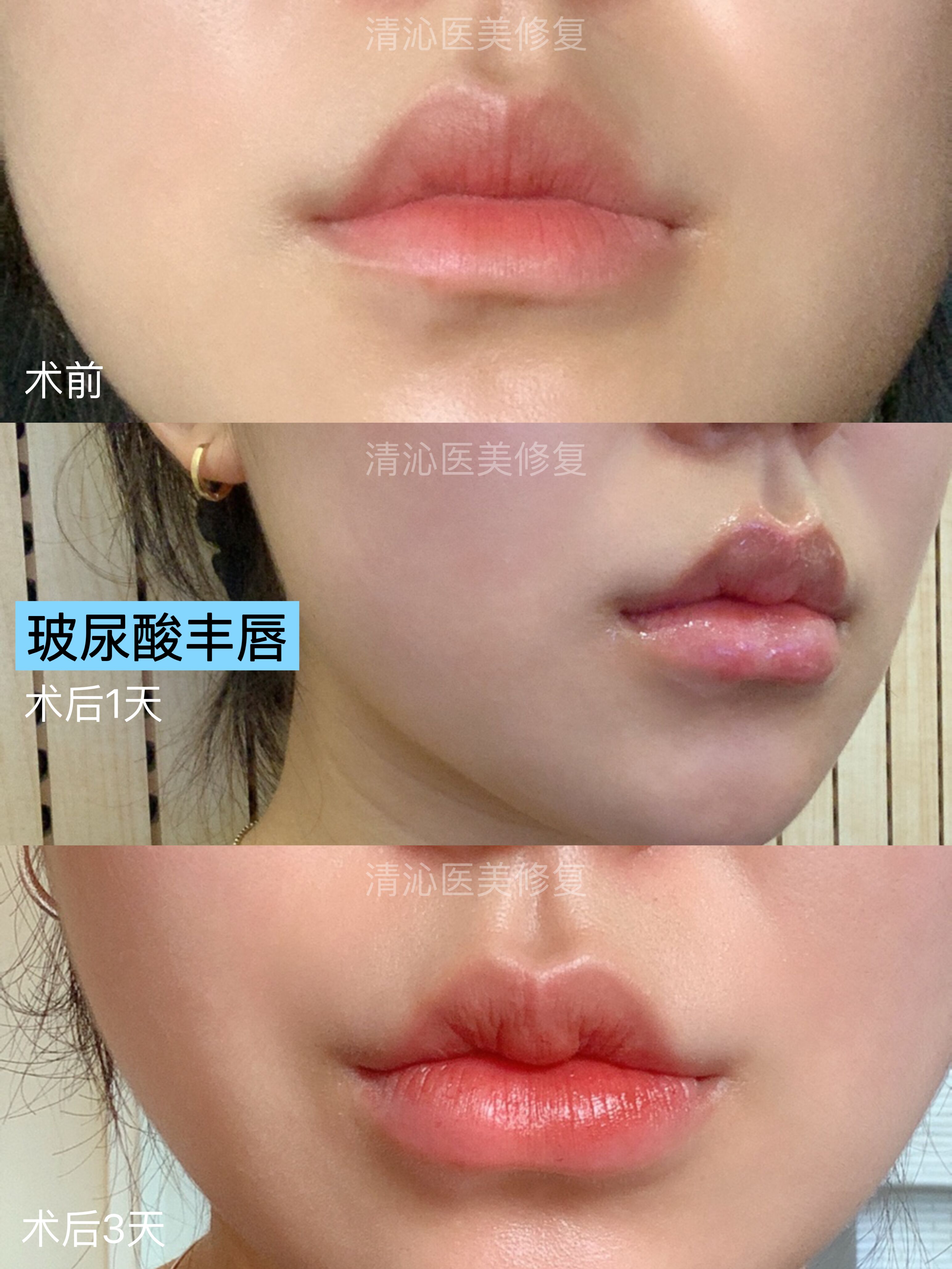 实时效果分享【玻尿酸丰唇术后3天】  玻尿酸丰唇后第1天只是微微肿胀