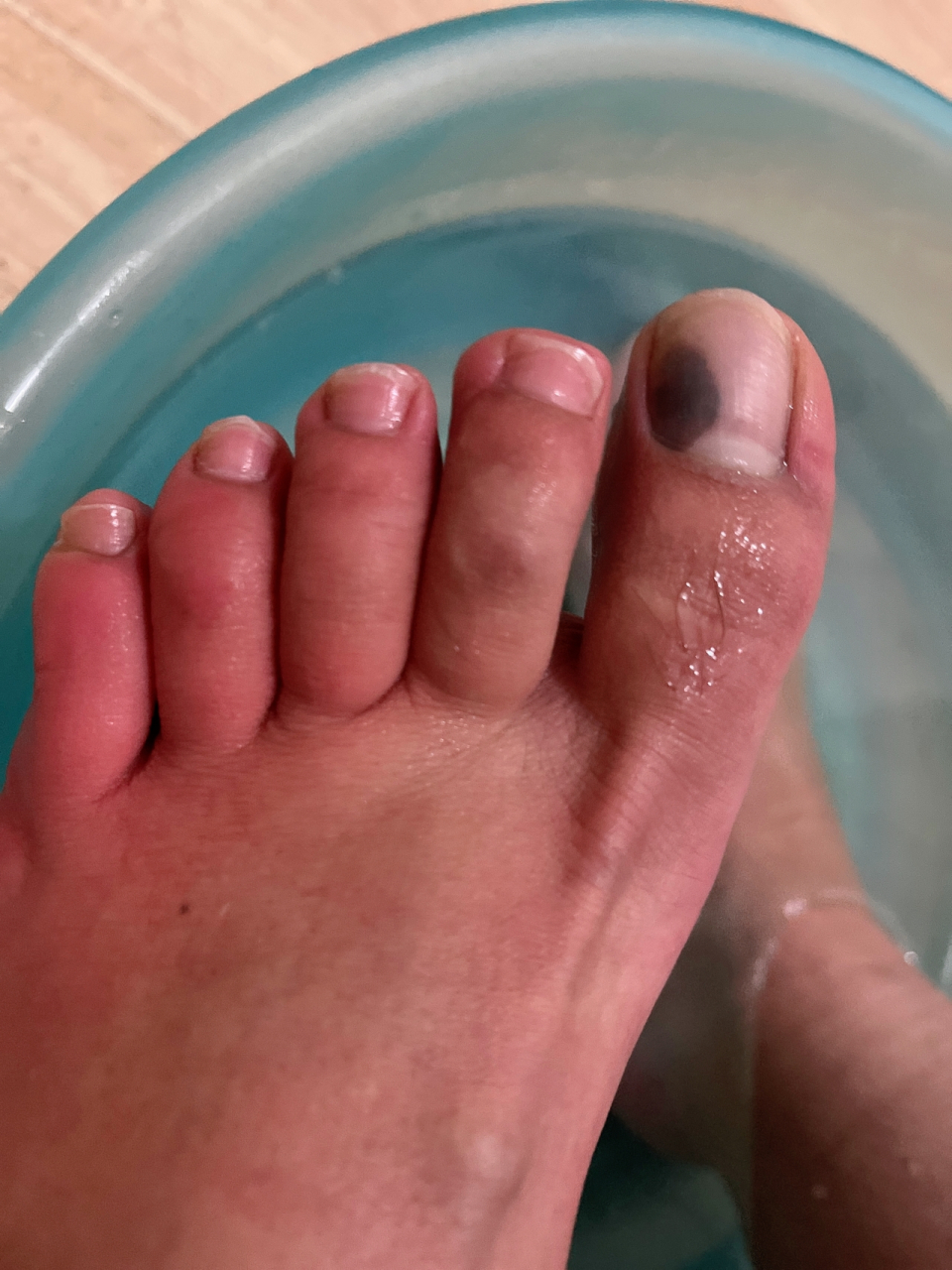 突然脚趾头黑了一块  有没有哪位姐妹知道这是什么情况?