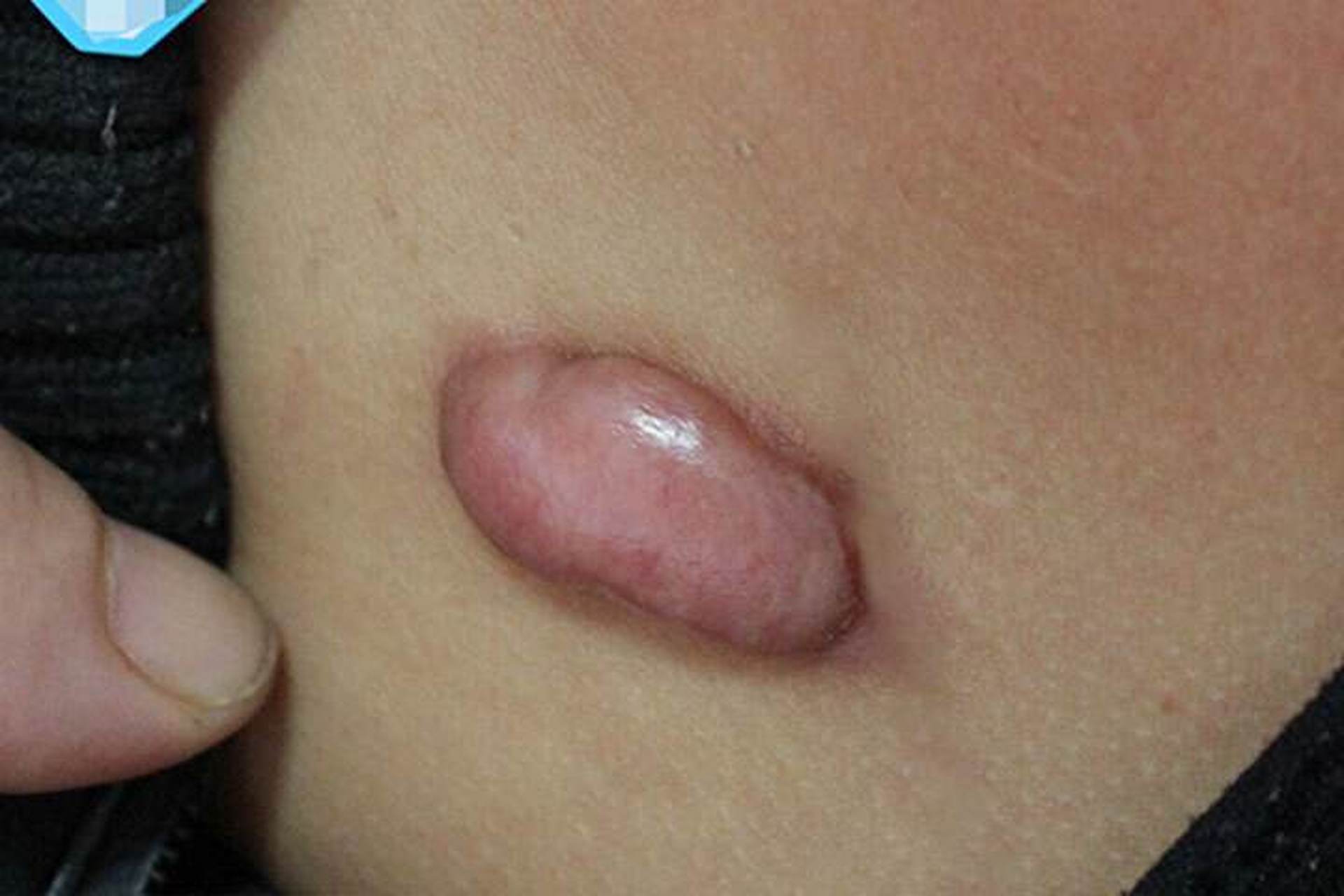 祛疤痕比较有效的方法.