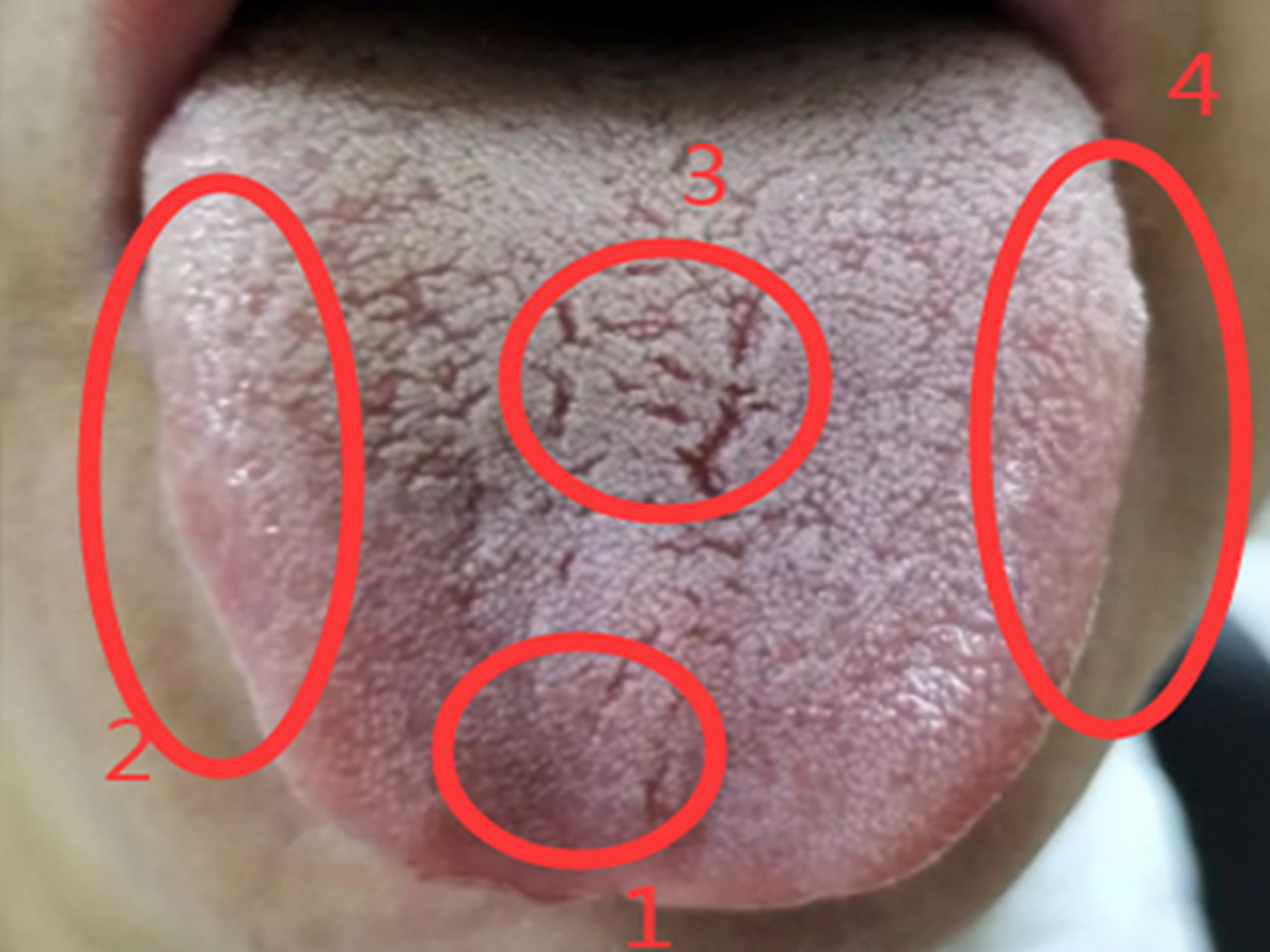 肝胆湿热舌苔症状图片图片