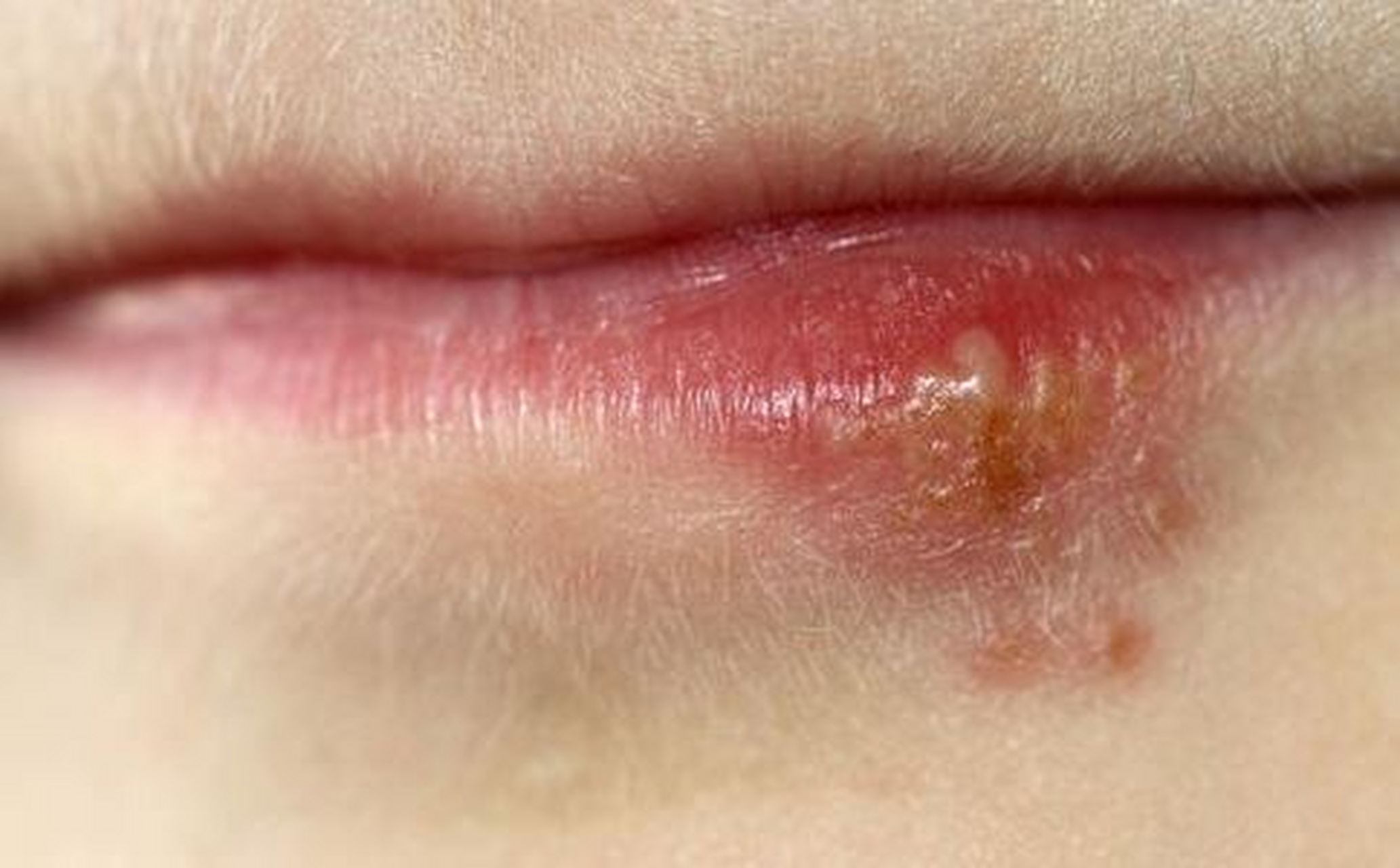 嘴角起泡是因为上火吗?