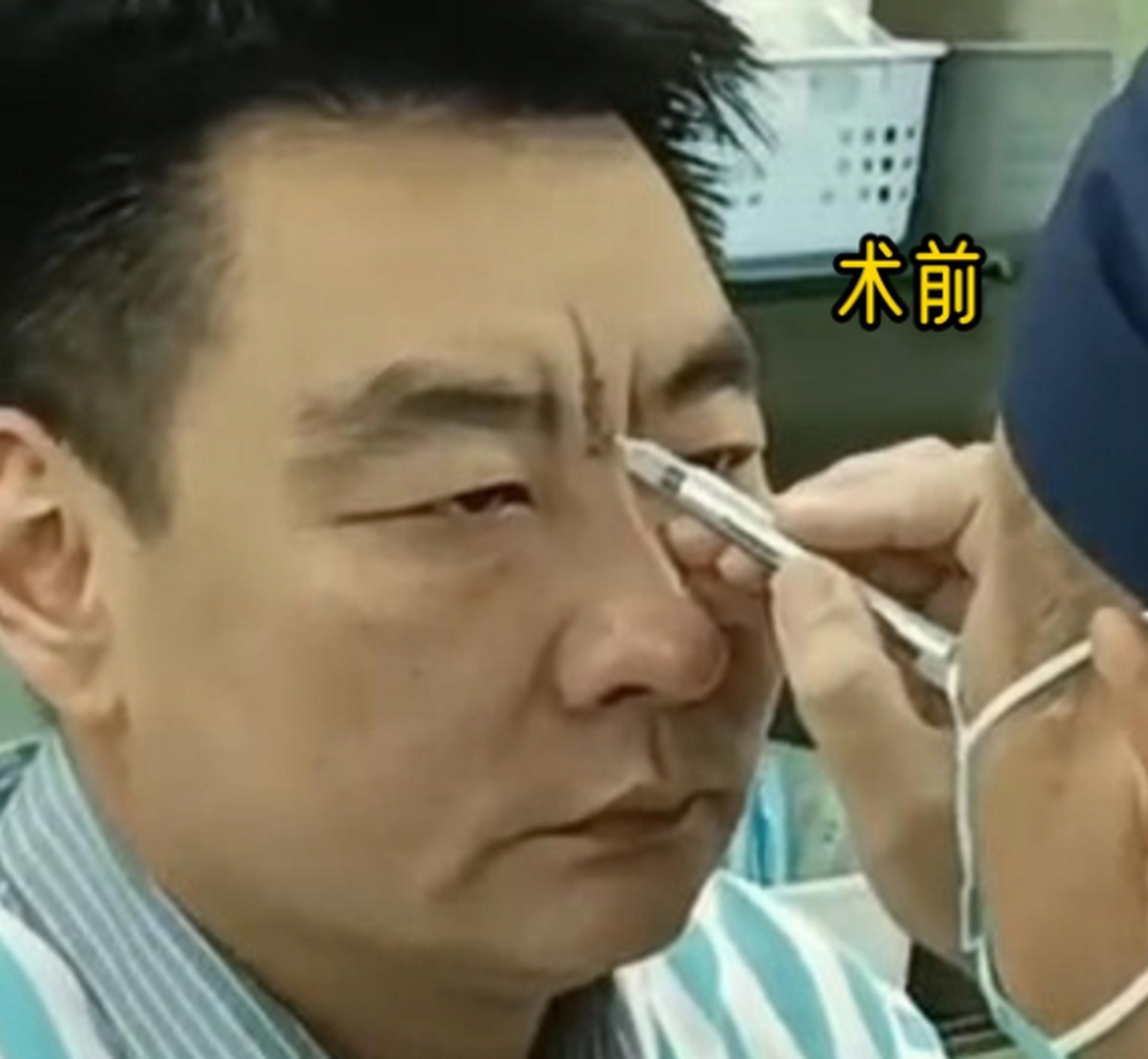 来看看这位有重度川字纹的男士,手术前后的效果吧~#川字纹# #祛川字纹