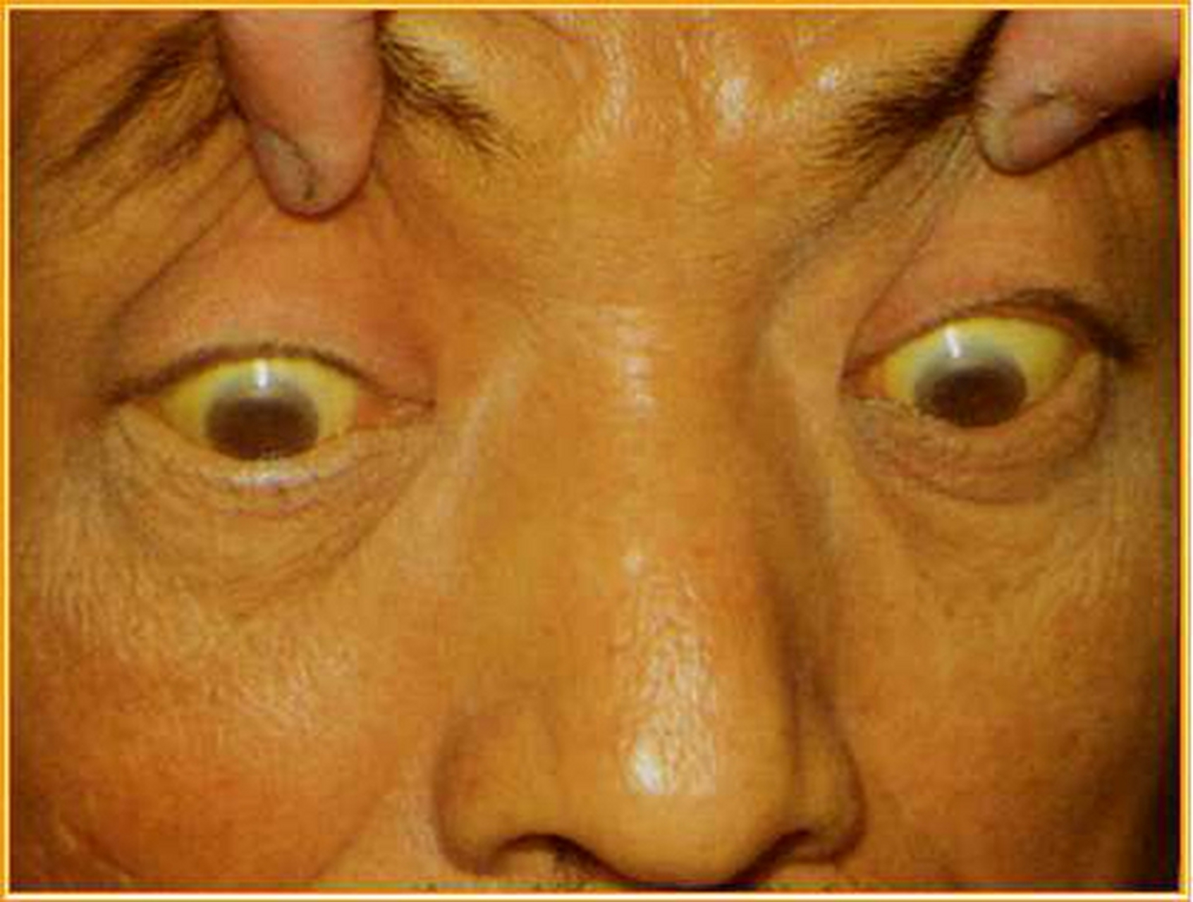 肝癌的眼睛图片图片