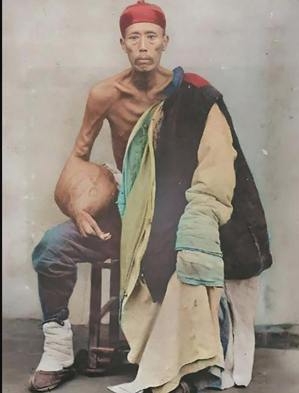 这是一个清朝男子,他的手上长了一个巨大的肿瘤,导致他连衣服都没有