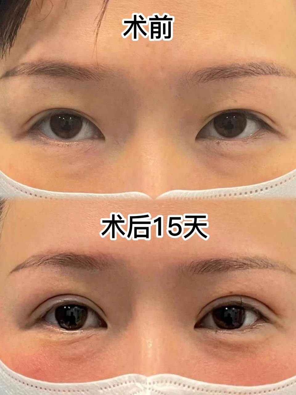 修复双眼皮的同时还把提肌做了,看事物也更清晰了.