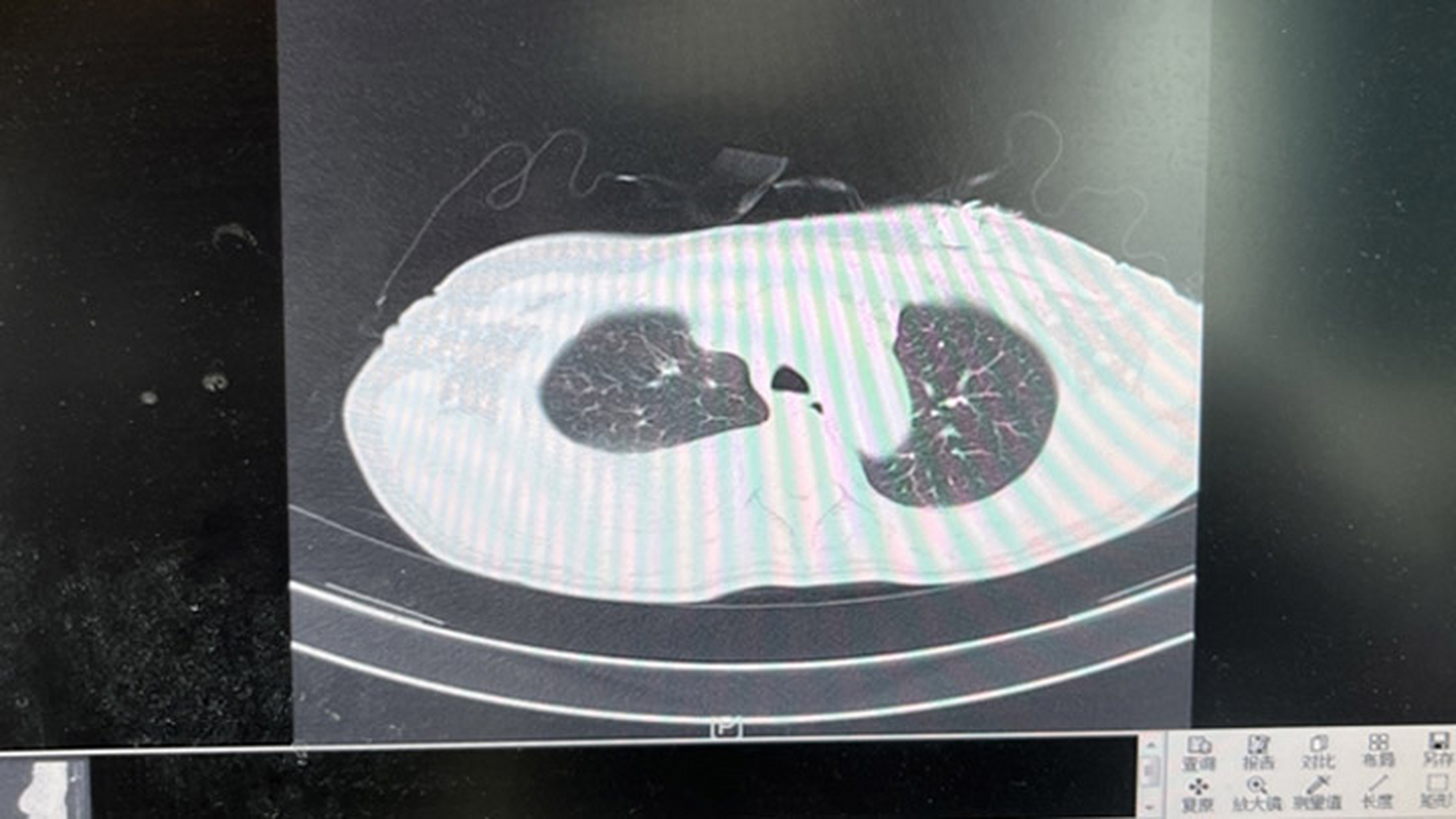 2018年发现右乳包块,pet-ct提示:右乳外上象限恶性肿瘤伴右侧腋窝