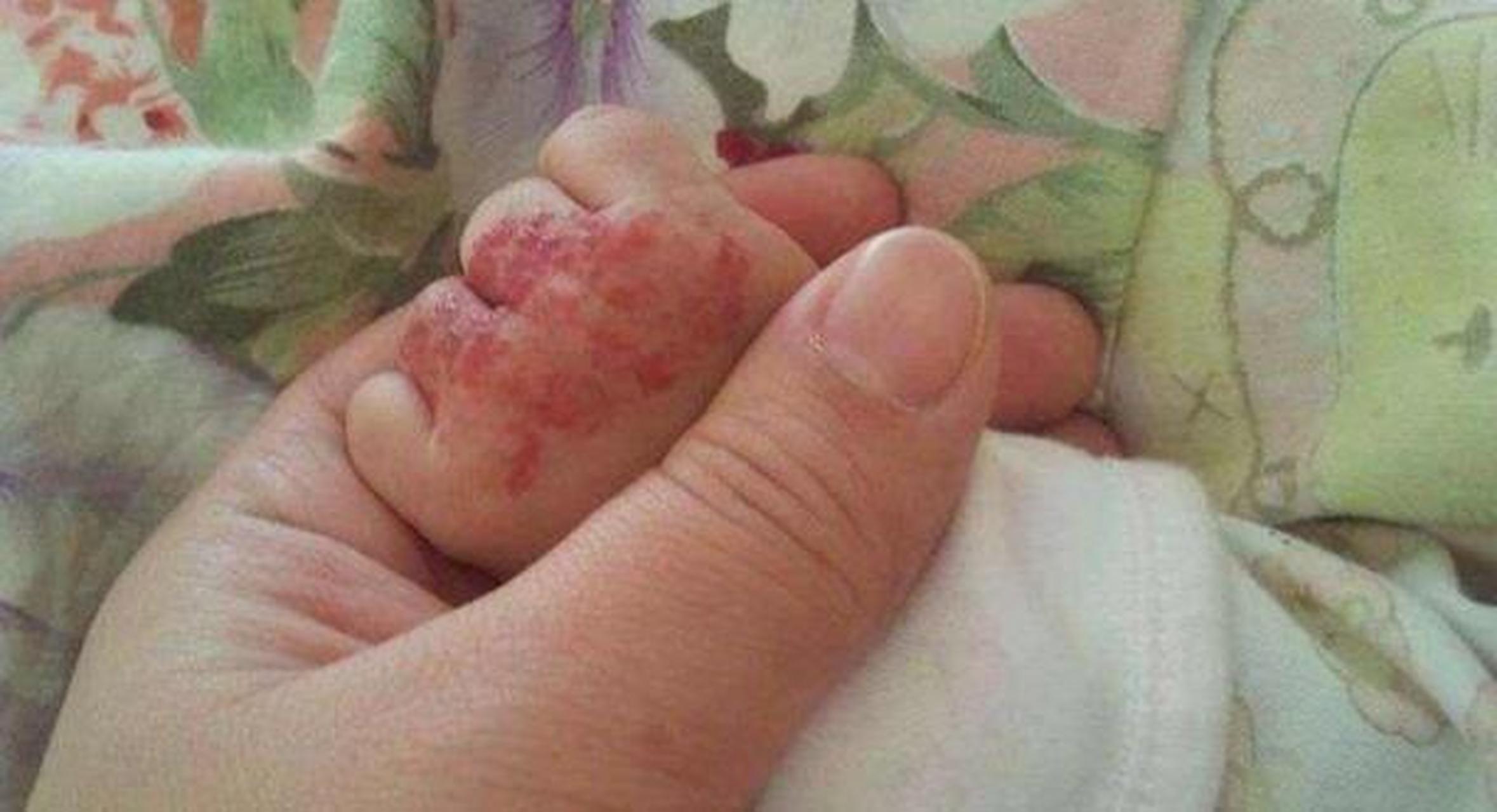 专家:早期血管瘤可从以下4个方面进行辨别!  1.颜色的异常改变.