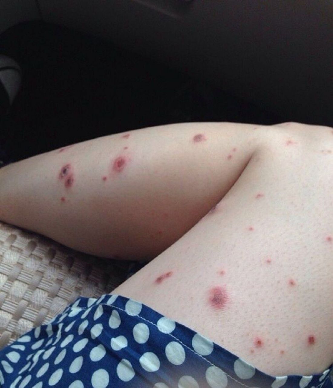 大腿内侧湿疹和股藓怎么治疗 - 大腿内侧出现湿疹和股癣,在诊断明确的