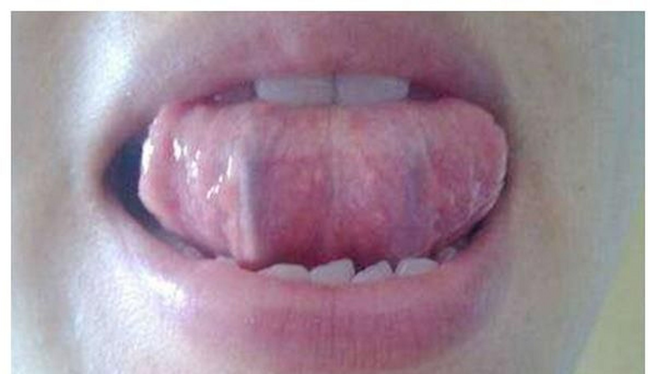 舌下青筋又粗又黑?胸痛如针刺?当心体内有瘀血!