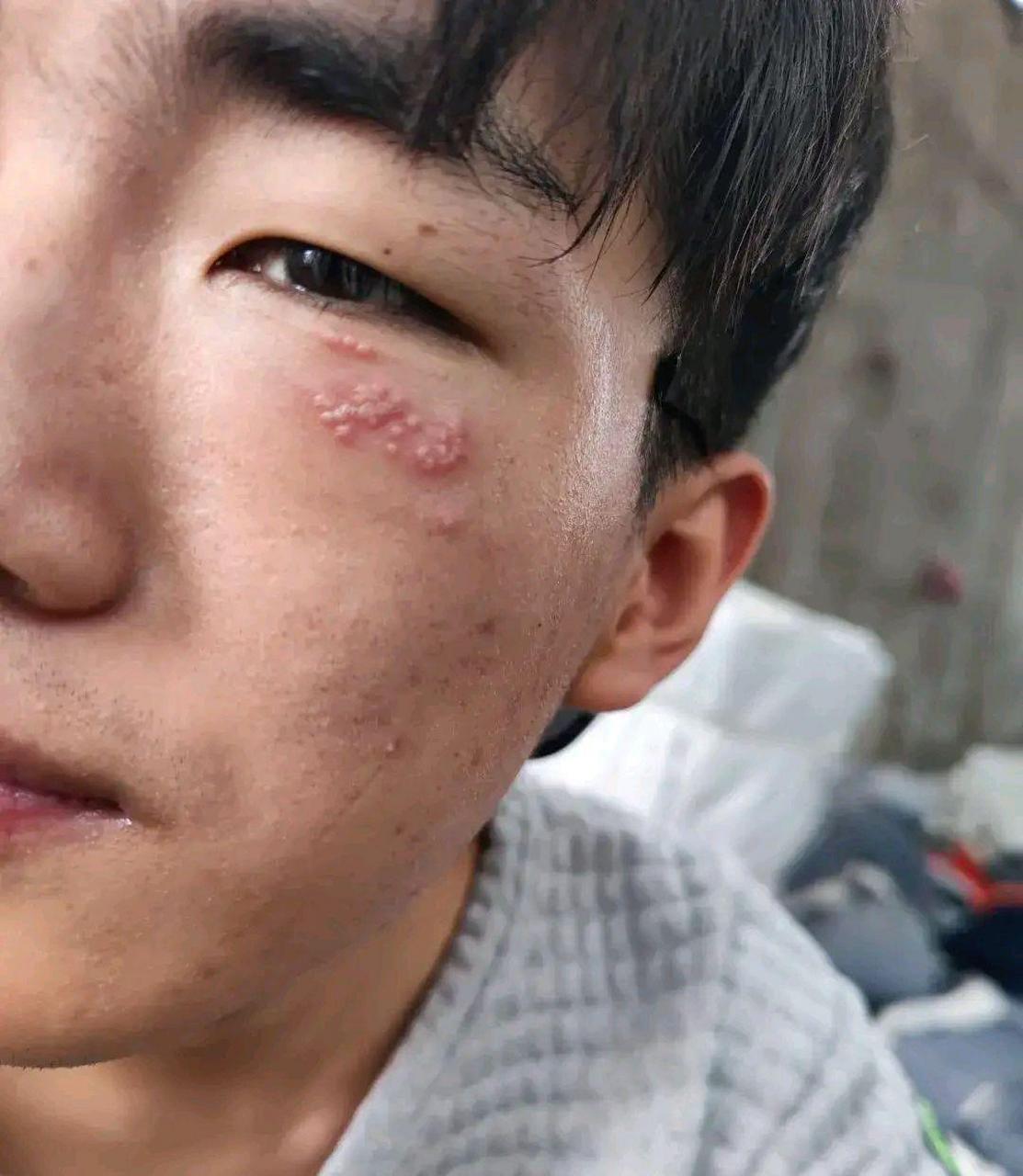 朋友脸上的,这是癌吗?