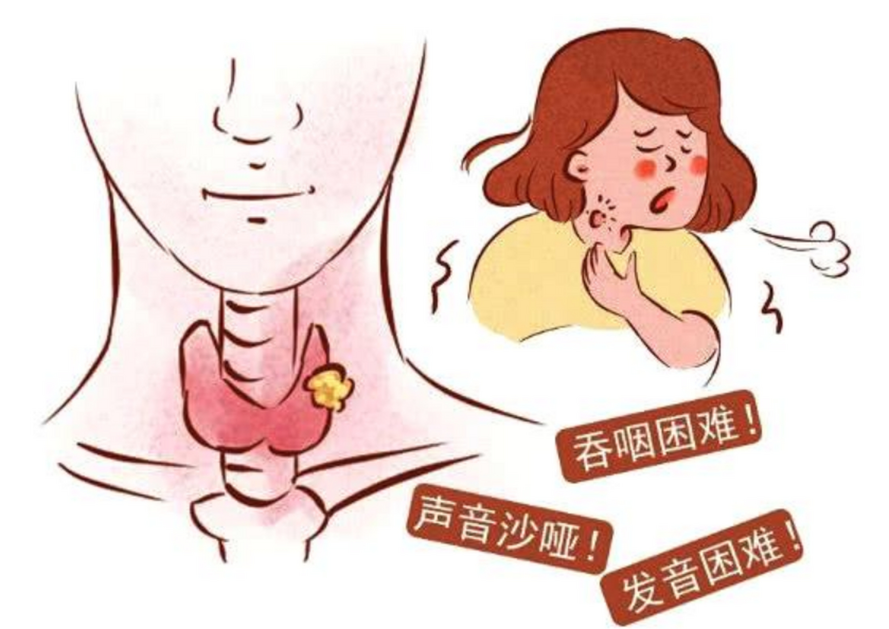 慢性咽炎的2大表现,看看你中了几条?