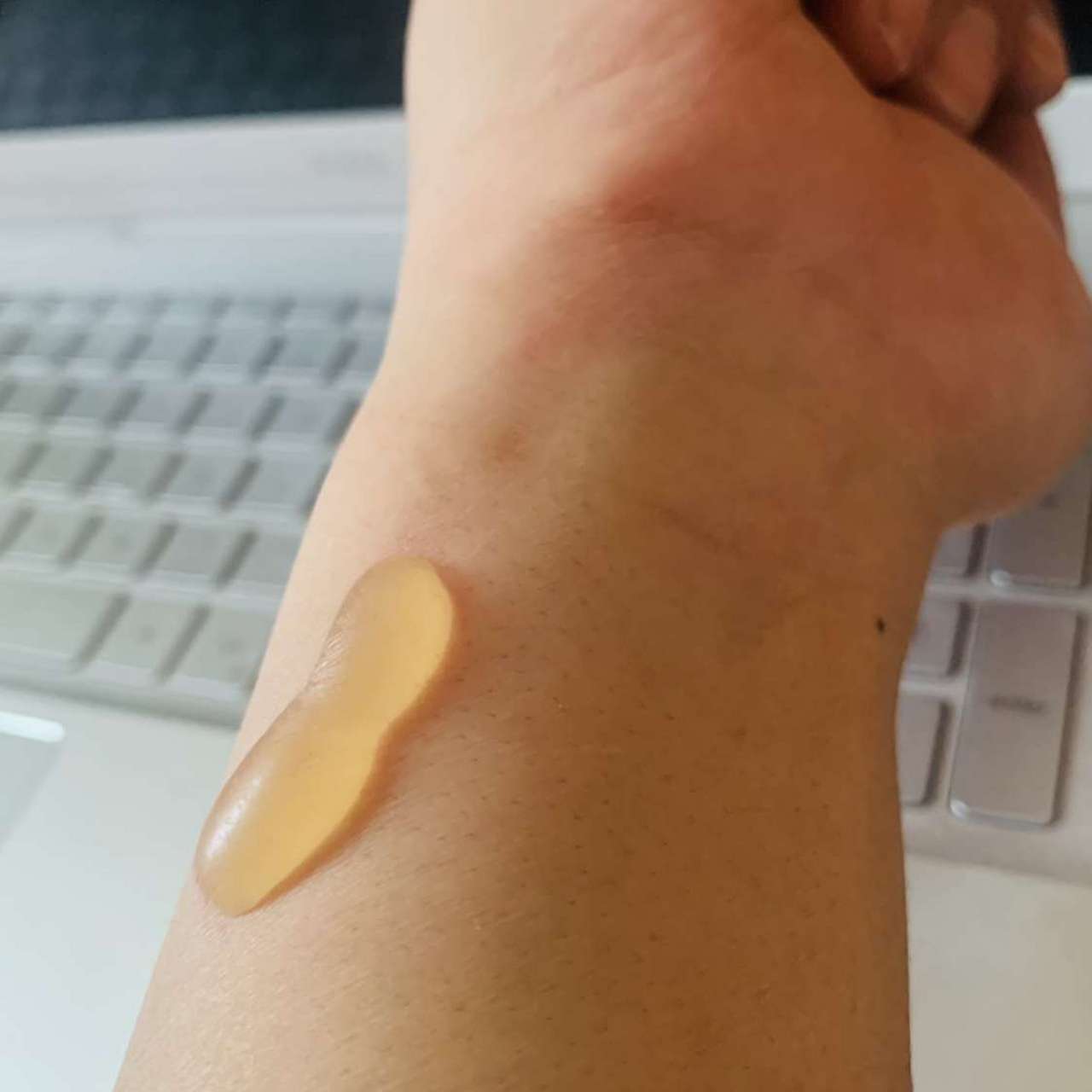 清早醒来发现手上好大一个水泡 啥情况