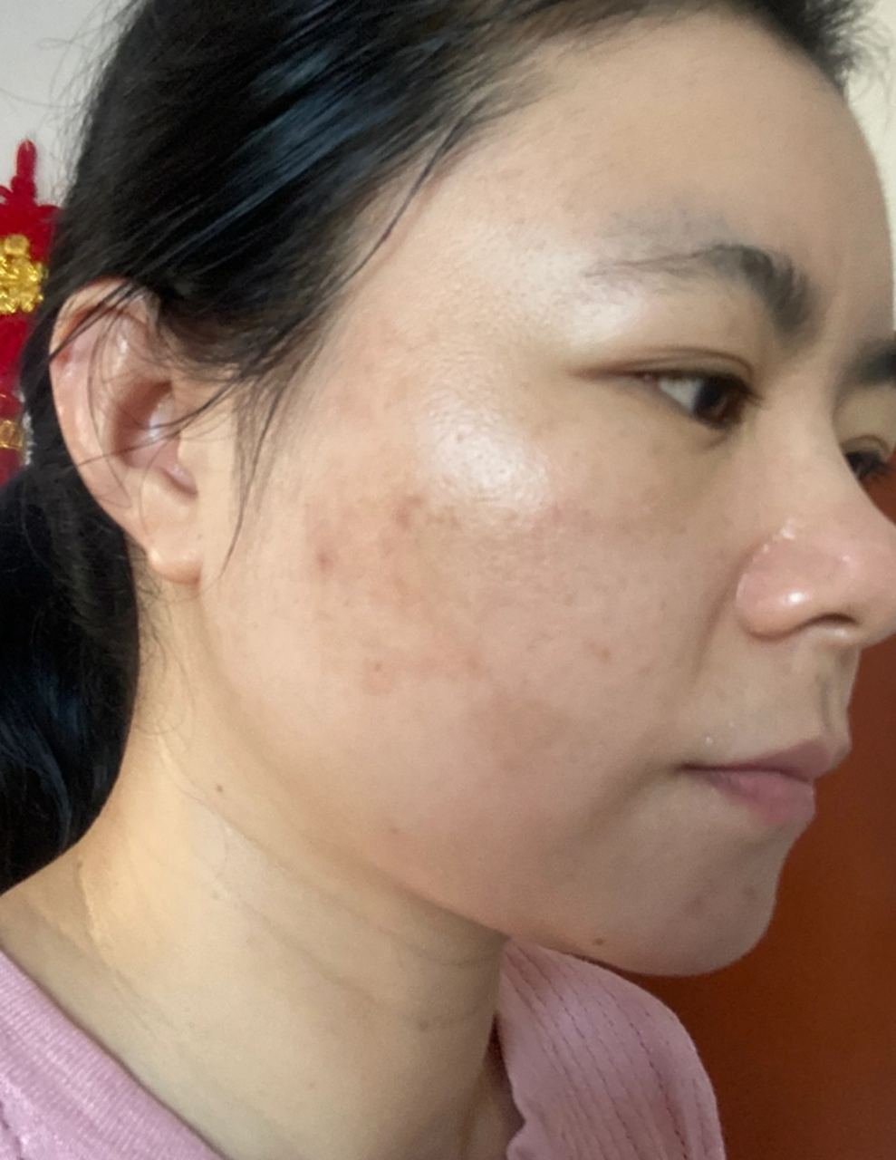 医美科普挑战赛#  脸上长黄褐斑是现代人面部皮肤常见的问题之一 