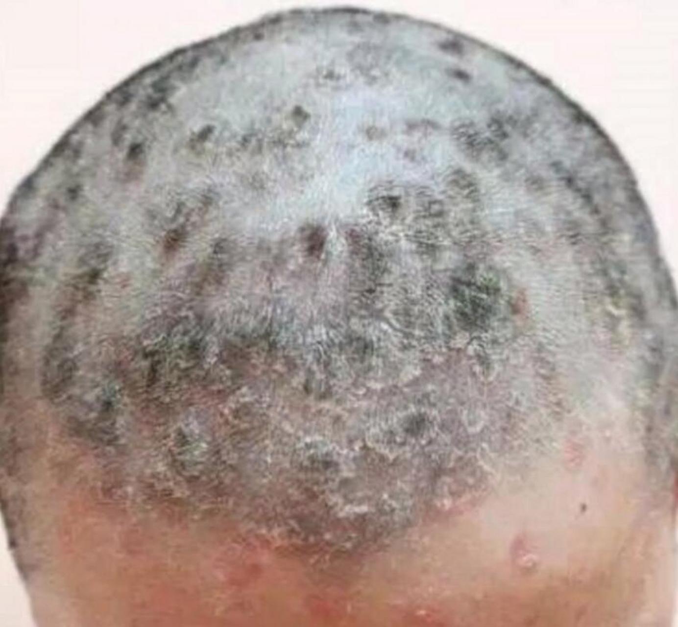 头皮型银屑病和脂溢性皮炎怎么辨别?