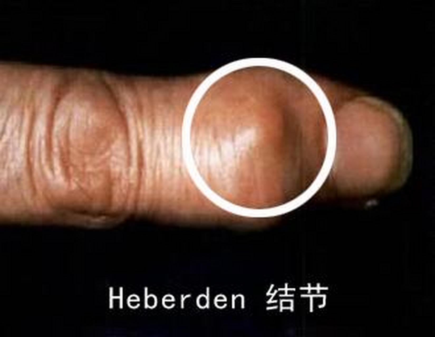 Heberden结节图片