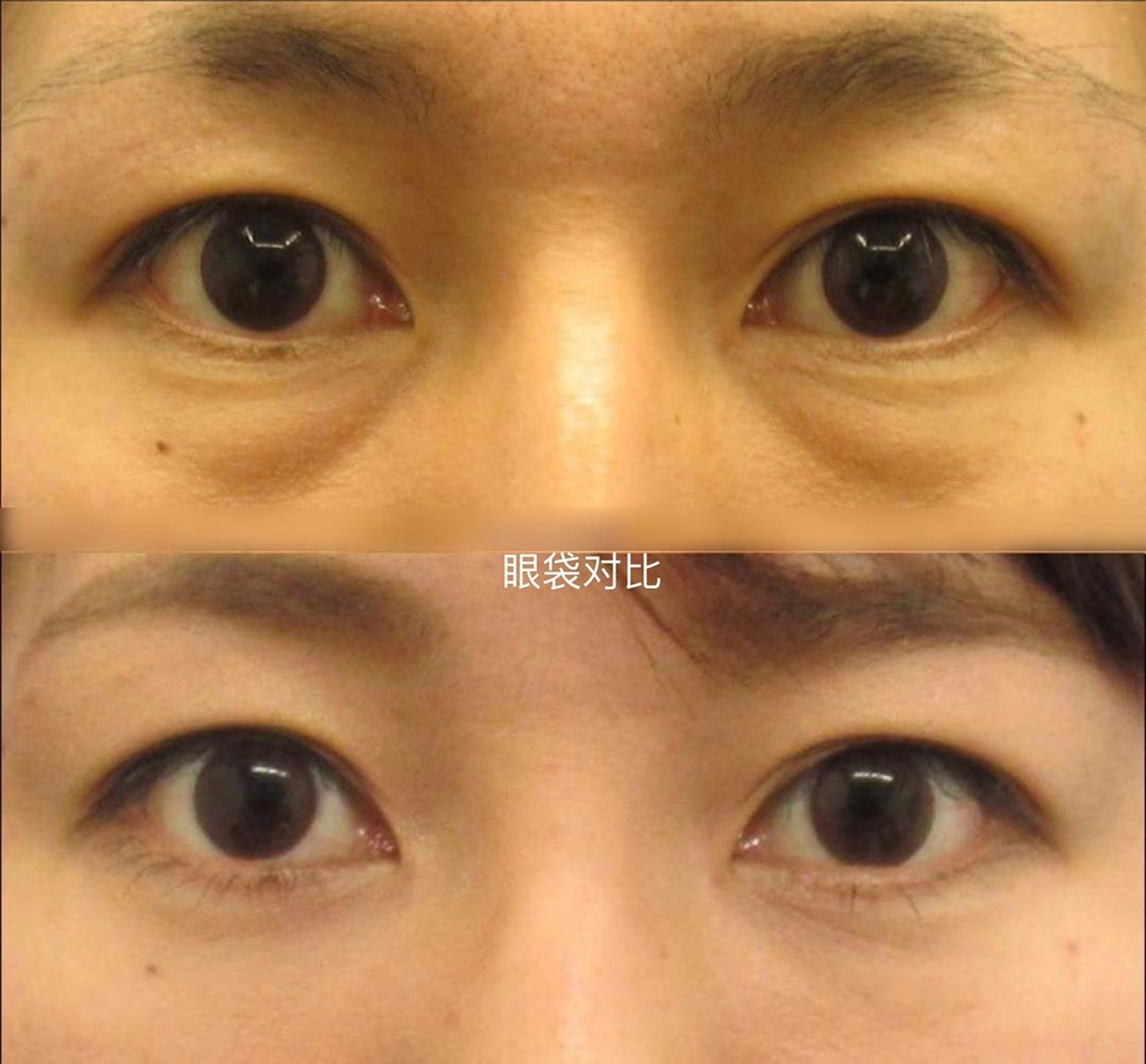 泪沟与眼袋的区别图  眼袋: 眼袋位于距下眼皮2-3cm的地方.