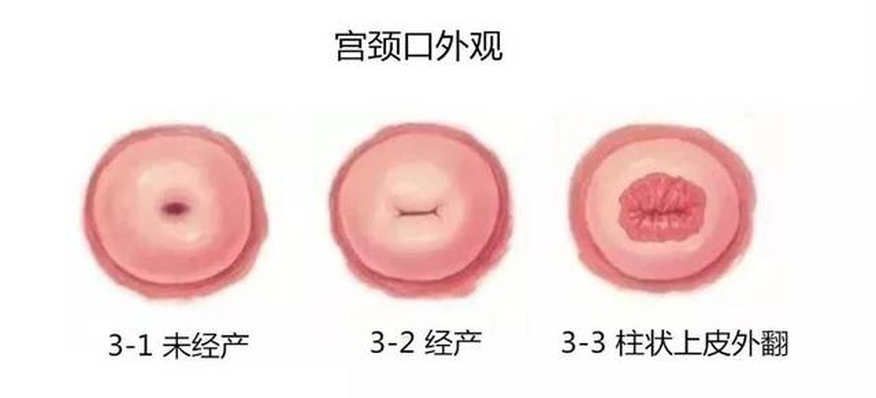 如果有医生跟你说:你的子宫糜烂情况很严重,需要立刻住院治疗