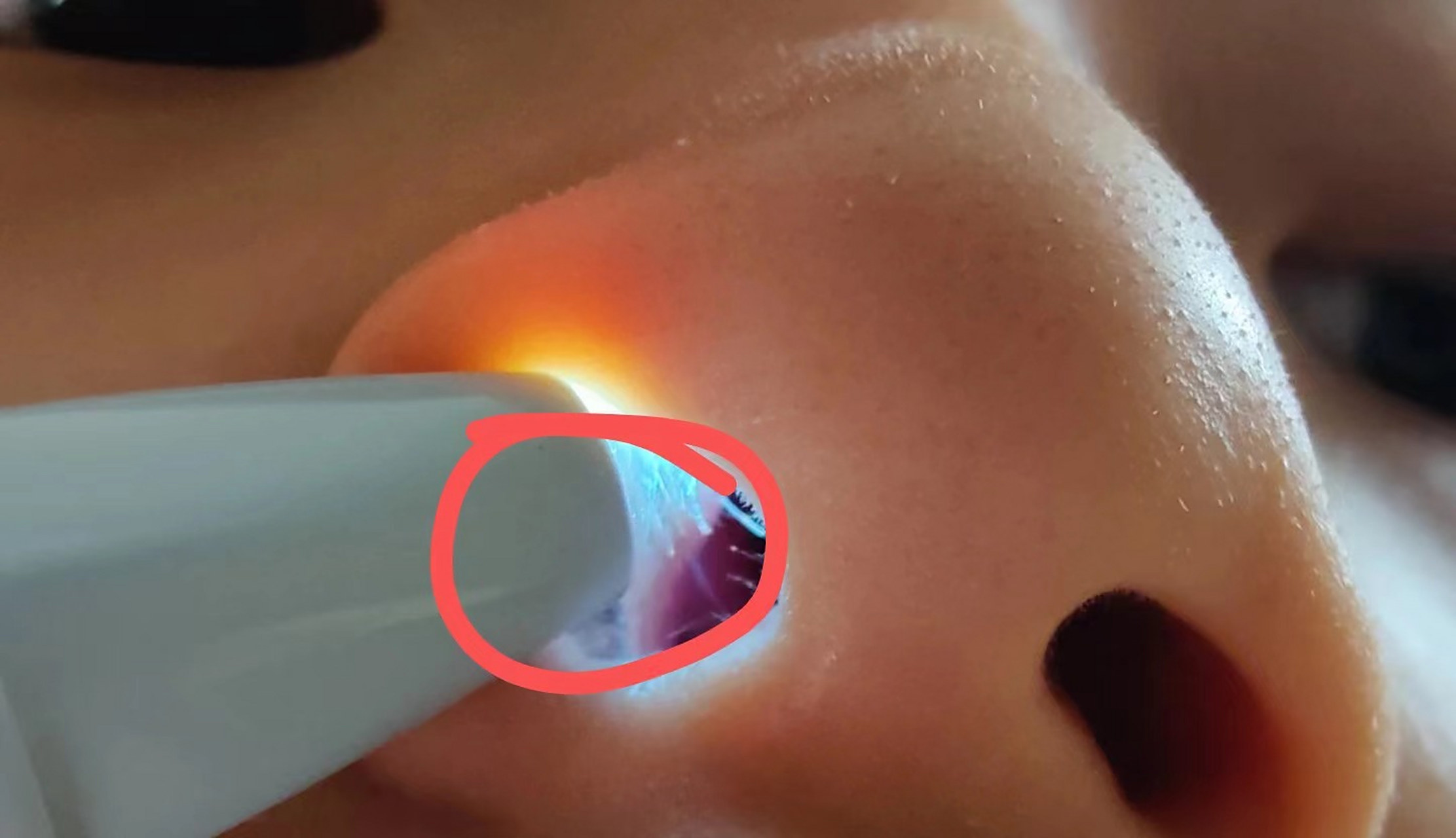 鼻甲肥大手术后鼻子过度通气,鼻腔干燥疼痛,鼻涕倒流加重.