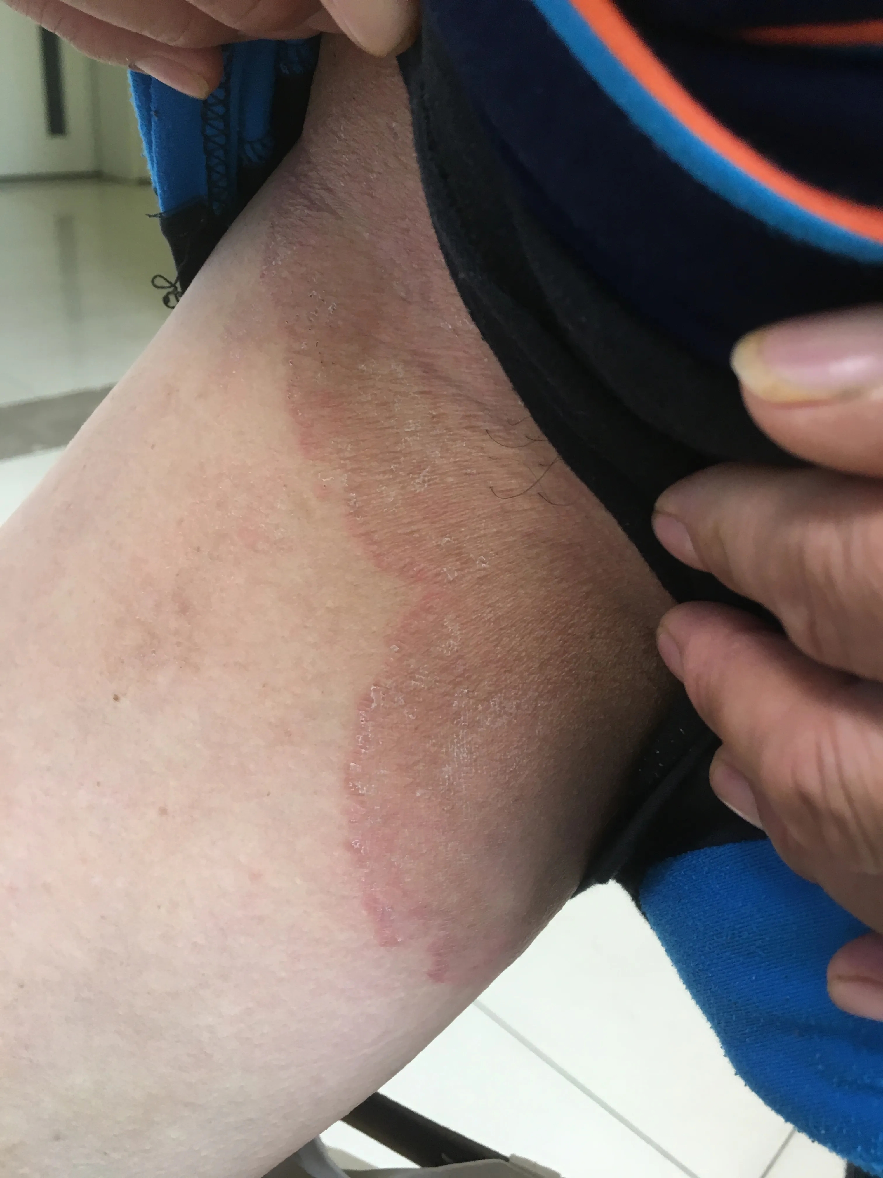 股藓四季豆会发生,小心这种.@中医皮肤胡博士的动态