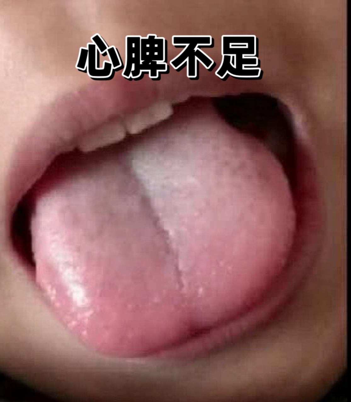 像有缺损,这种情况说明孩子心阳不足; 02 舌尖的缺损凹陷和舌中脾胃
