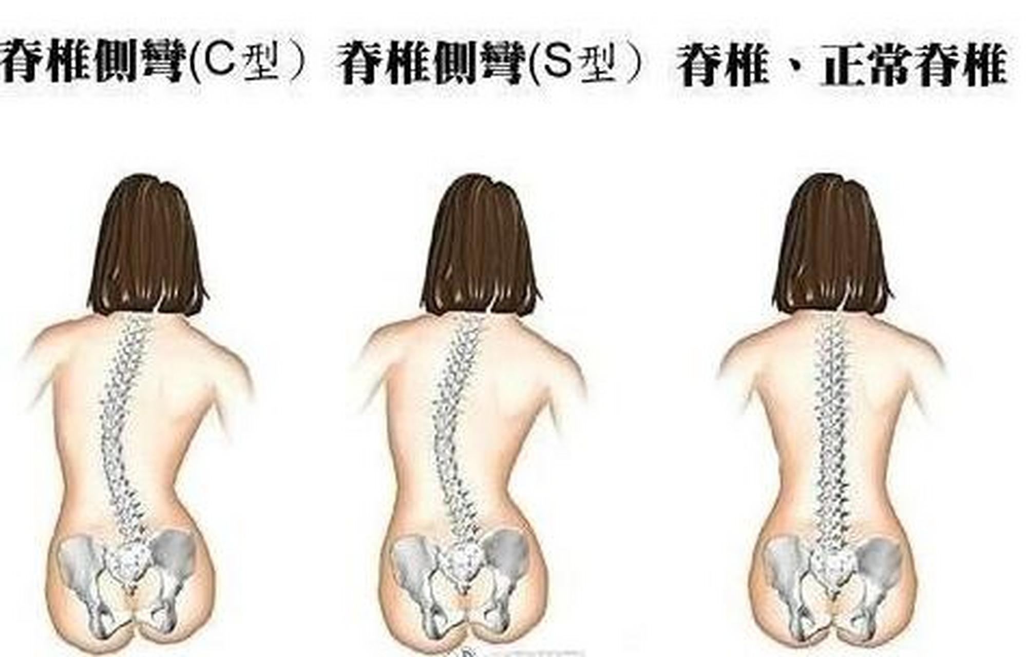 长期跷二郎腿,易弯腰驼背,腰椎,胸椎和脊椎的压力分布不均,造成肌肉