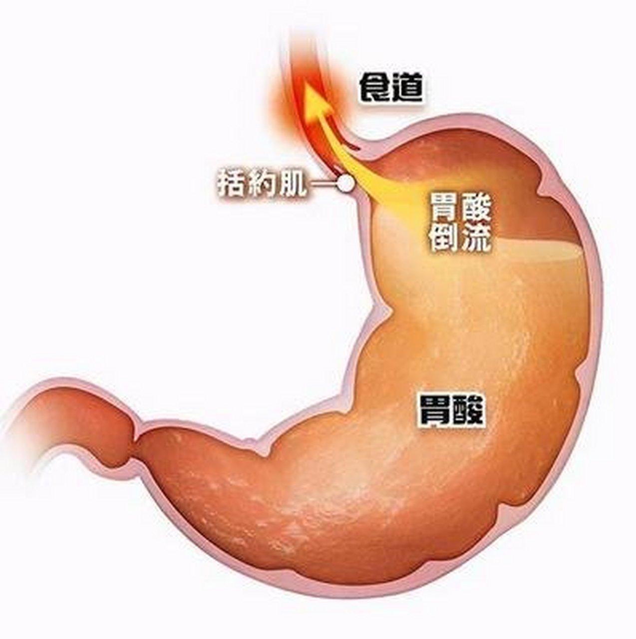 胃食管反流病,也有一部分因素是因为长期进食过快导致的,长期因素快会