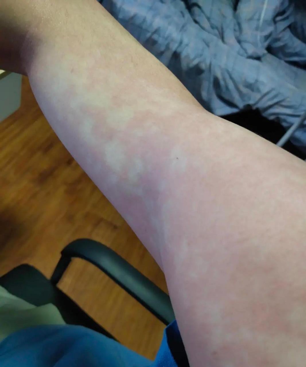 这是酒精过敏吗? #中国版chatgpt来了# #趣图搞笑