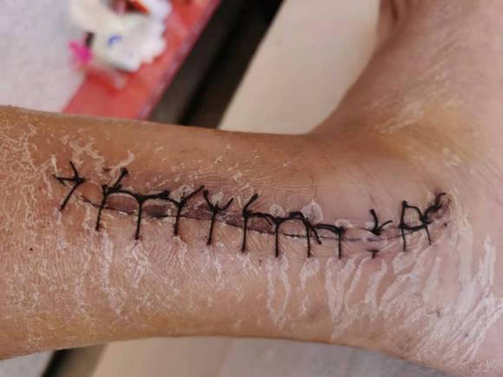 三踝骨折全流程问题全解----取钢板,术后恢复,下地 31566 #骨折