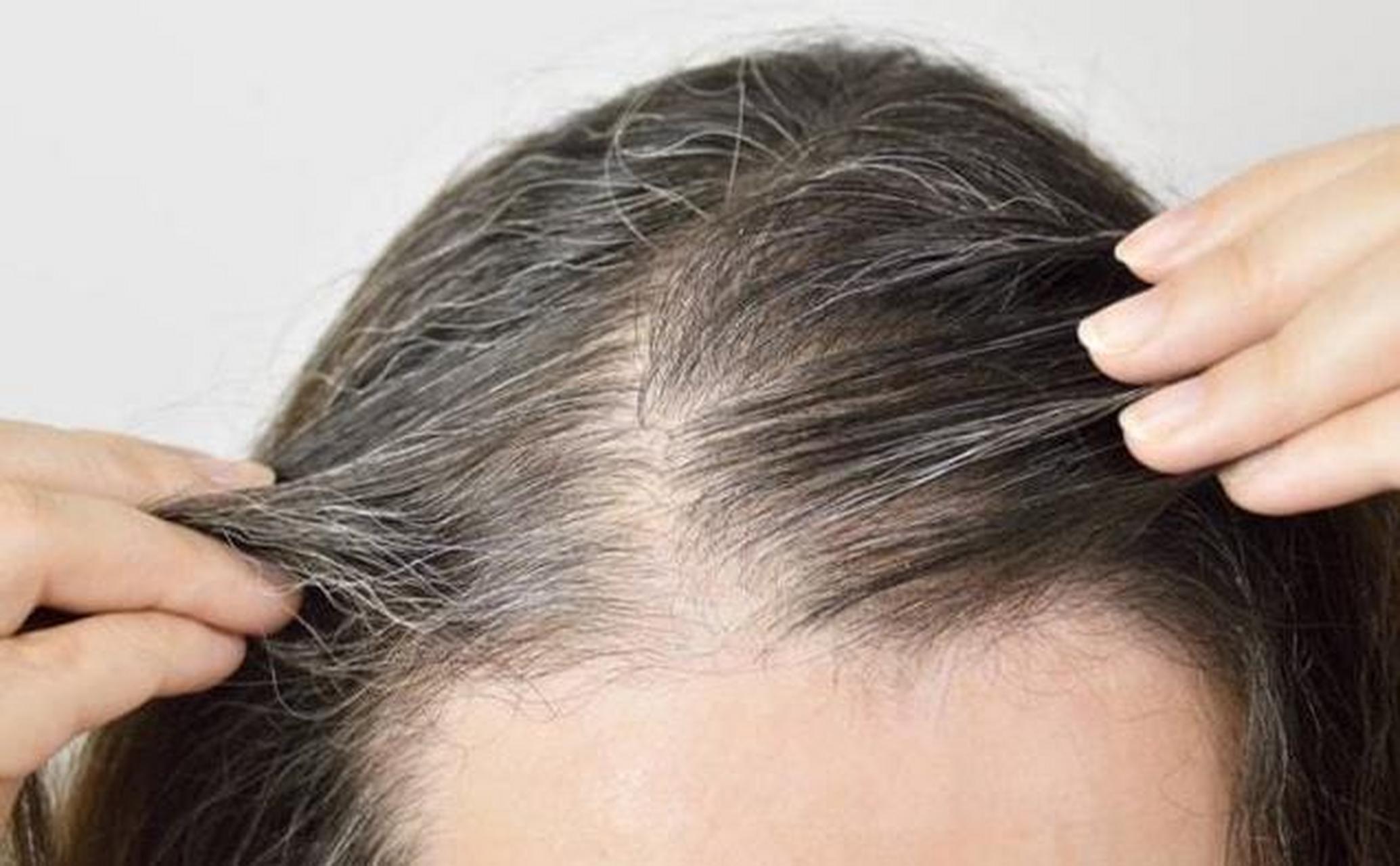 白头发不建议拔的原因: ①拔白头发会使毛囊受到轻度损伤,三个月后