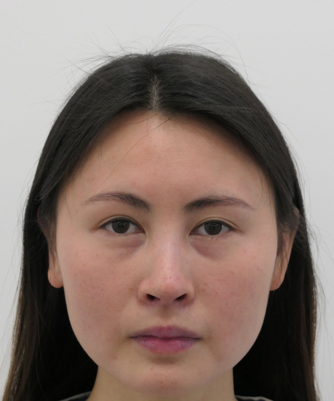 姑娘术前下眼睑皮肤松弛,袋囊突出,并且出现两道明显的泪沟,既憔悴