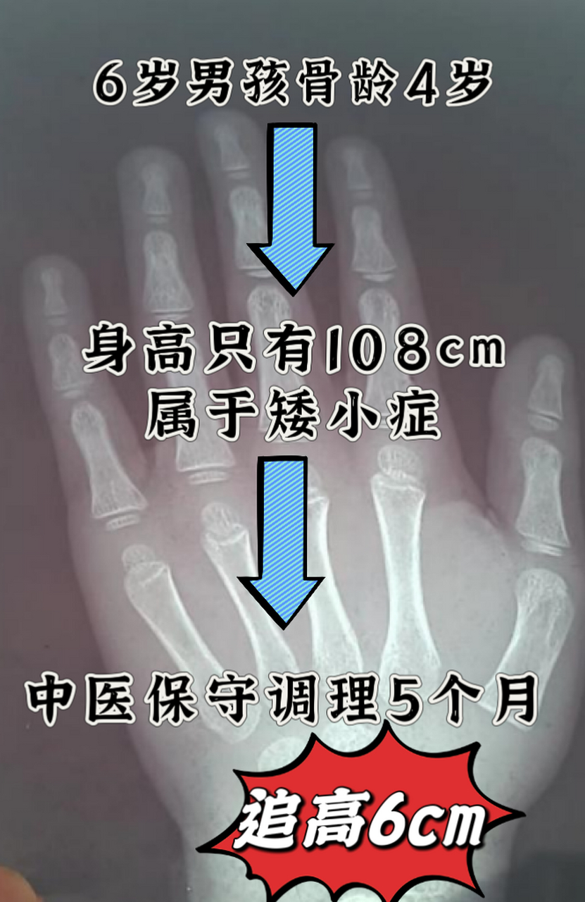 前不久,我接诊了一名6岁男孩,身高只有108cm,属于矮小症范畴.