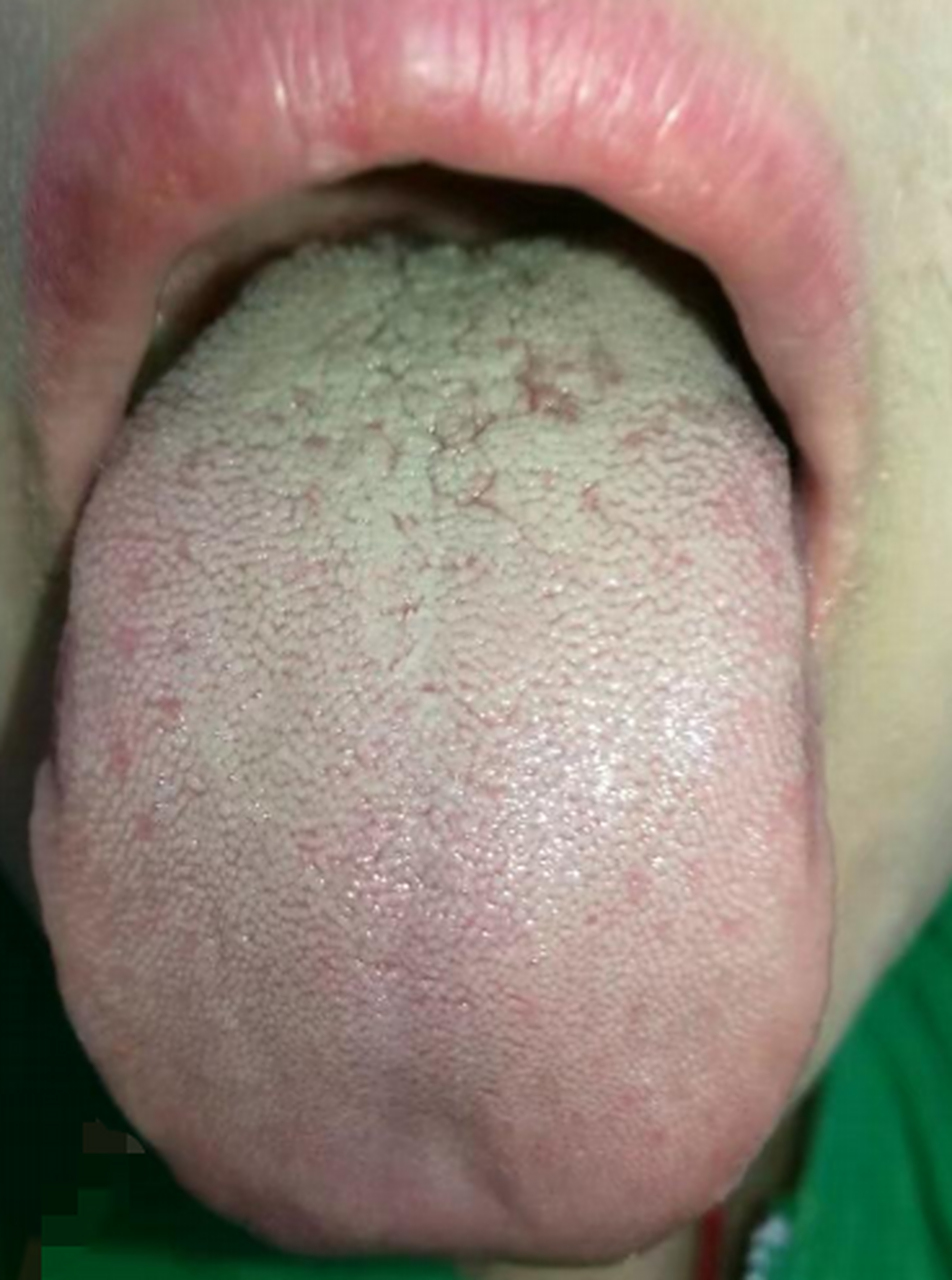 这个患者的舌根特点:舌根窄,舌体鼓胀,舌苔厚腻,有细小的纹路