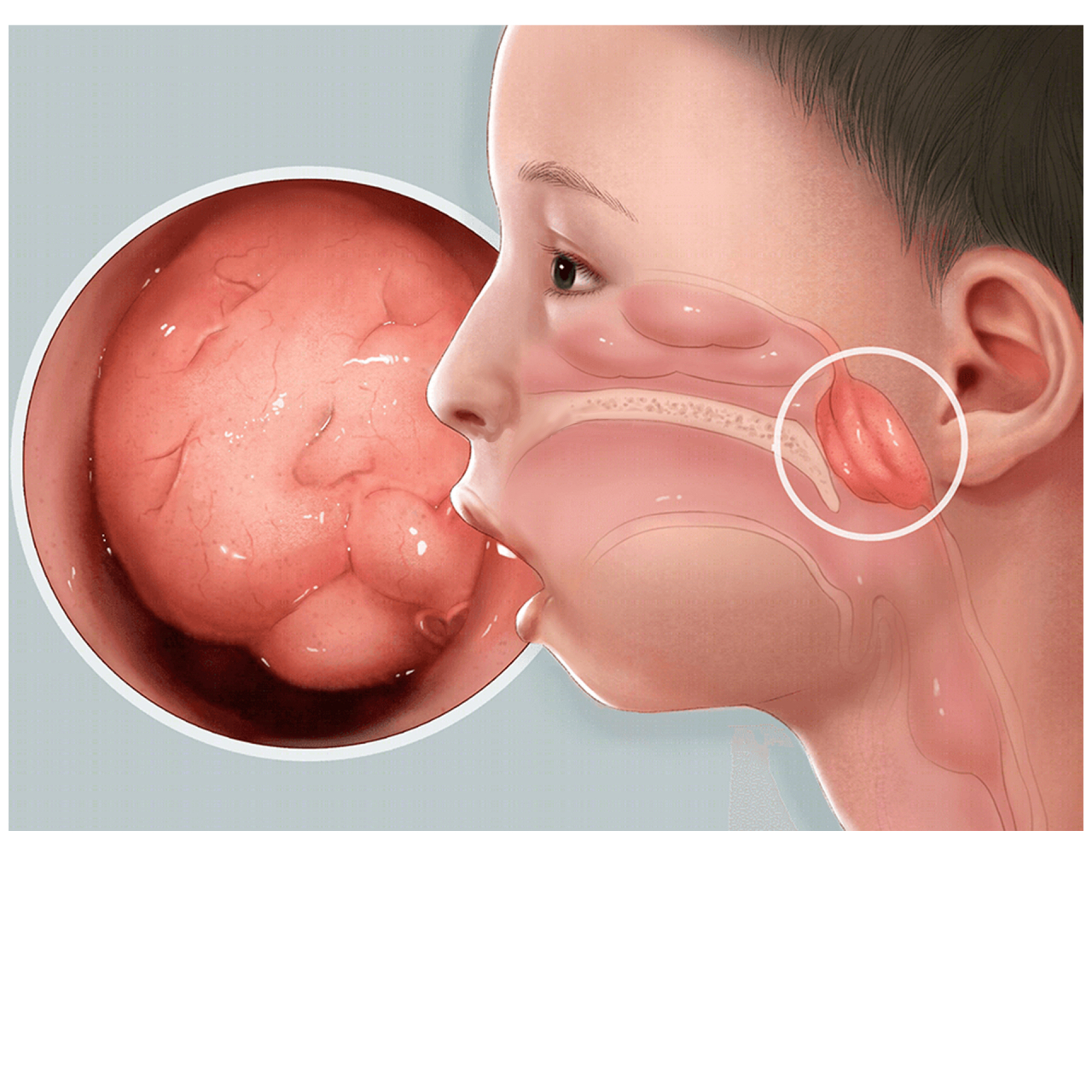 一个小方法帮助缩小腺样体,如果孩子有腺样体肥大,可以在家里辅助按摩