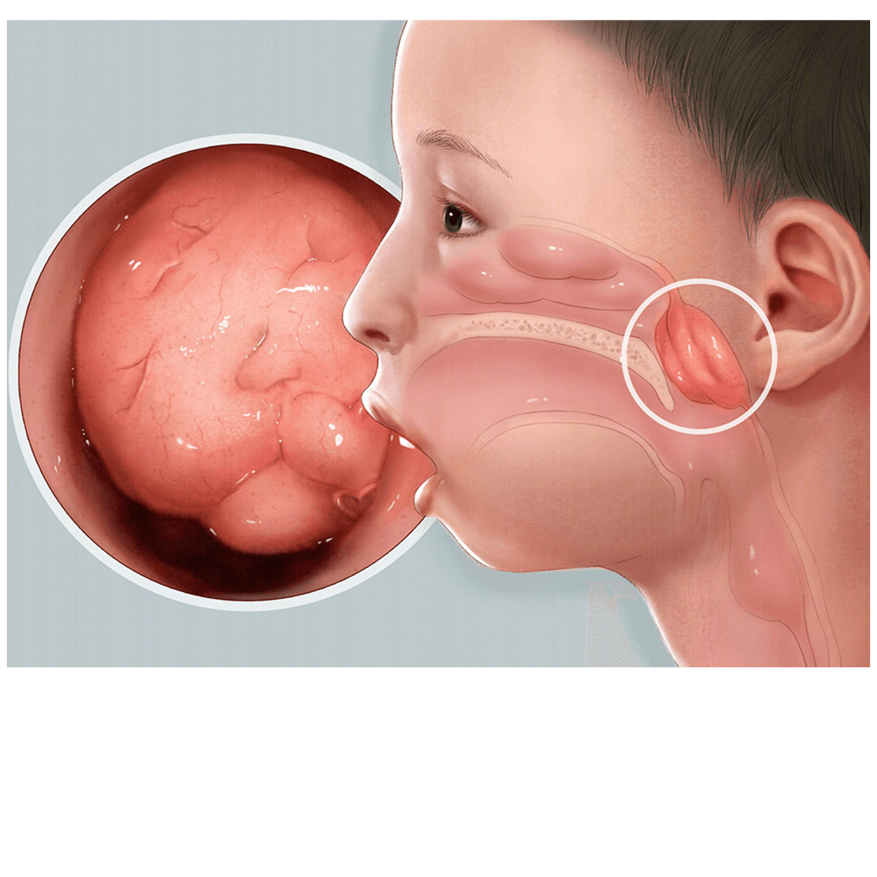 腺样体肥大的位置图片图片
