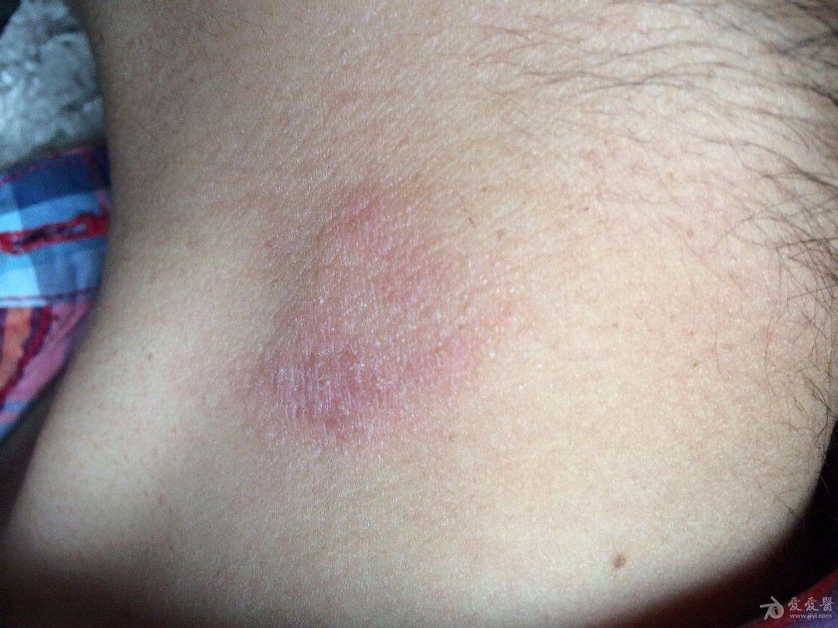 很多人都搞不清楚神经性皮炎和湿疹,盲目用药,导致皮损越来越严重