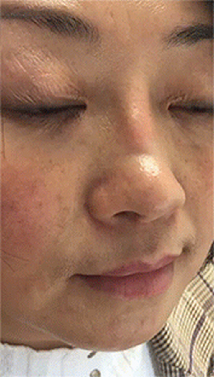 出现假体"断层"? 为什么老路一次次强调:让大家选择正规医院?