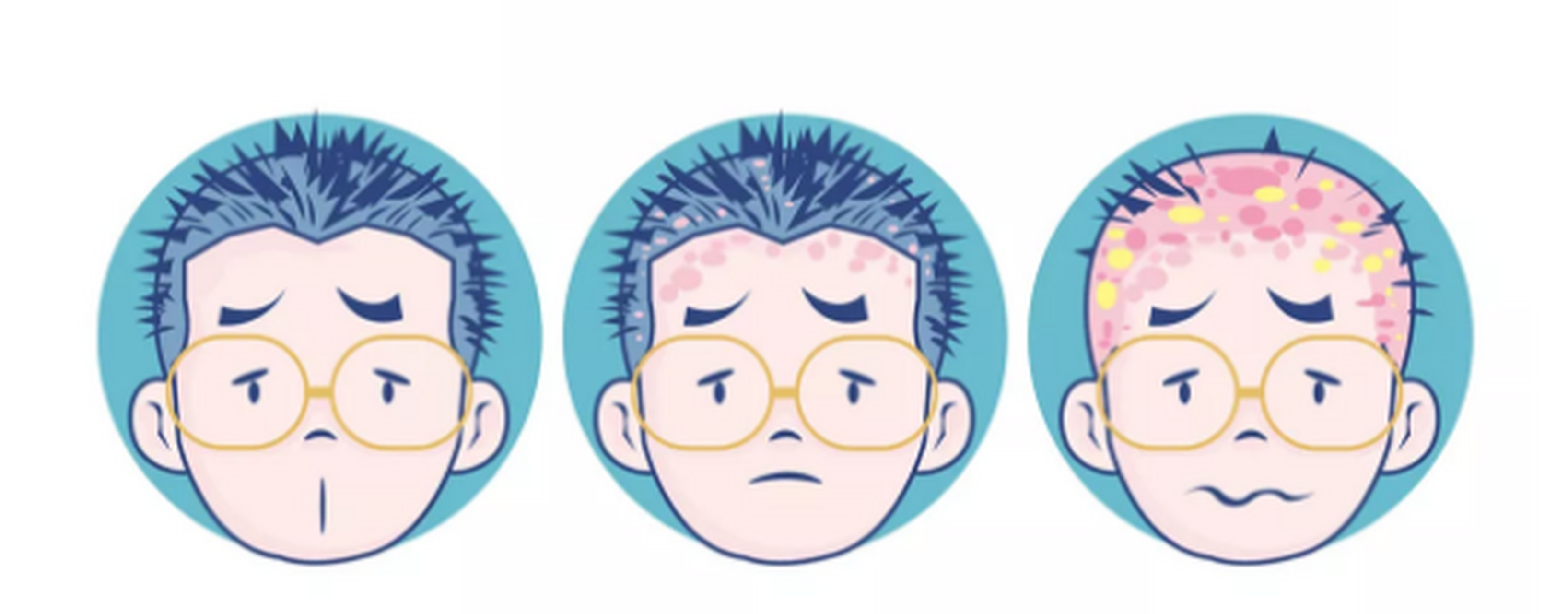 银屑病是一种慢性炎症性皮肤病,患病后会出现脱屑