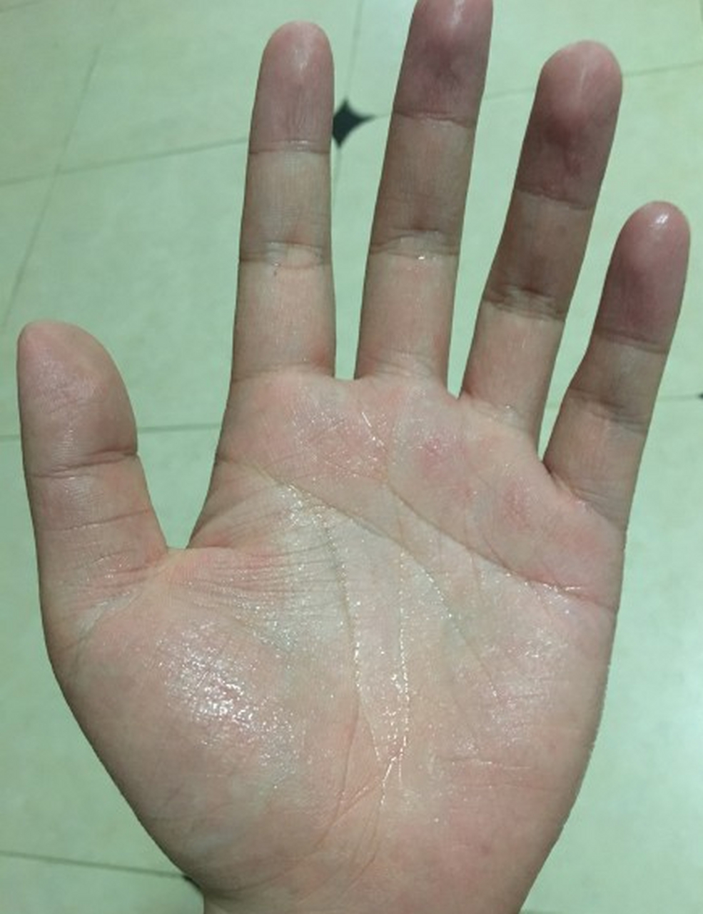 手足多汗 手汗症是由于交感神经过度兴奋引起汗腺过多分泌的一种疾病
