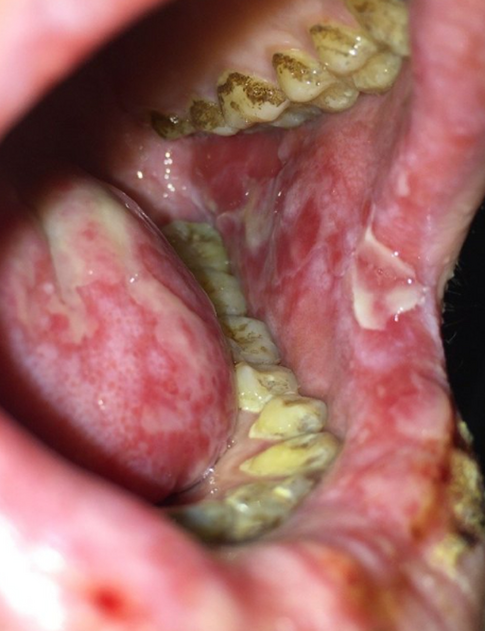 口腔黏膜扁平苔藓图图片