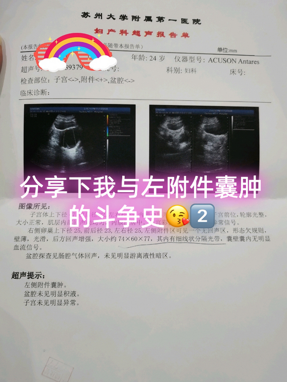 分享下我与左附件囊肿的斗争史[观望]21566  晚上十点半,听到有人