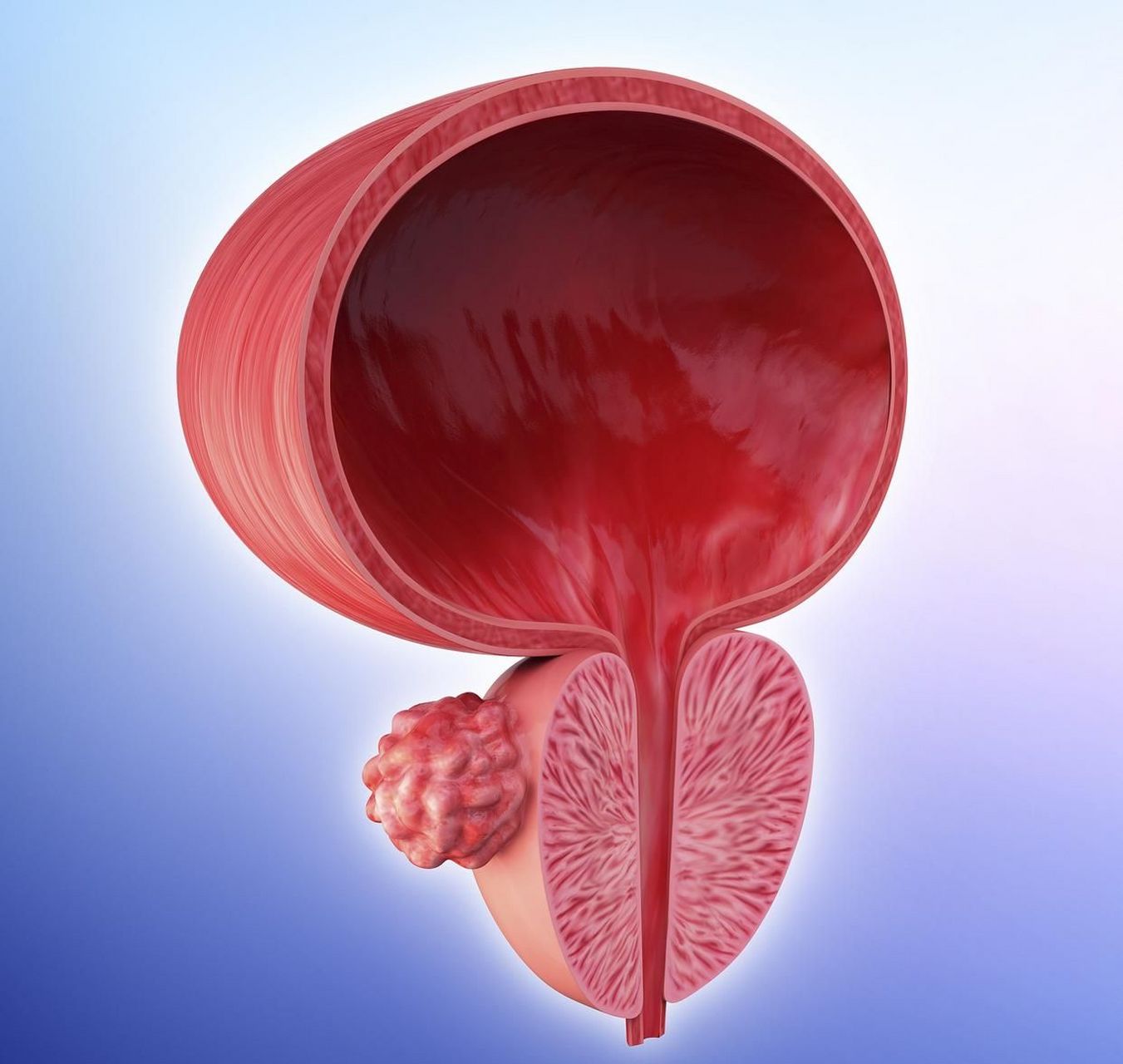 吸烟是目前最为肯定的膀胱癌致病危险因素,研究表明高达30%～50%的