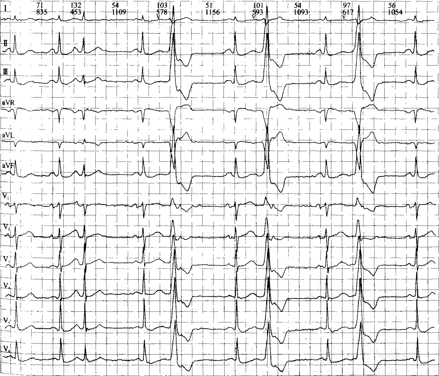 室性早搏典型心电图图片
