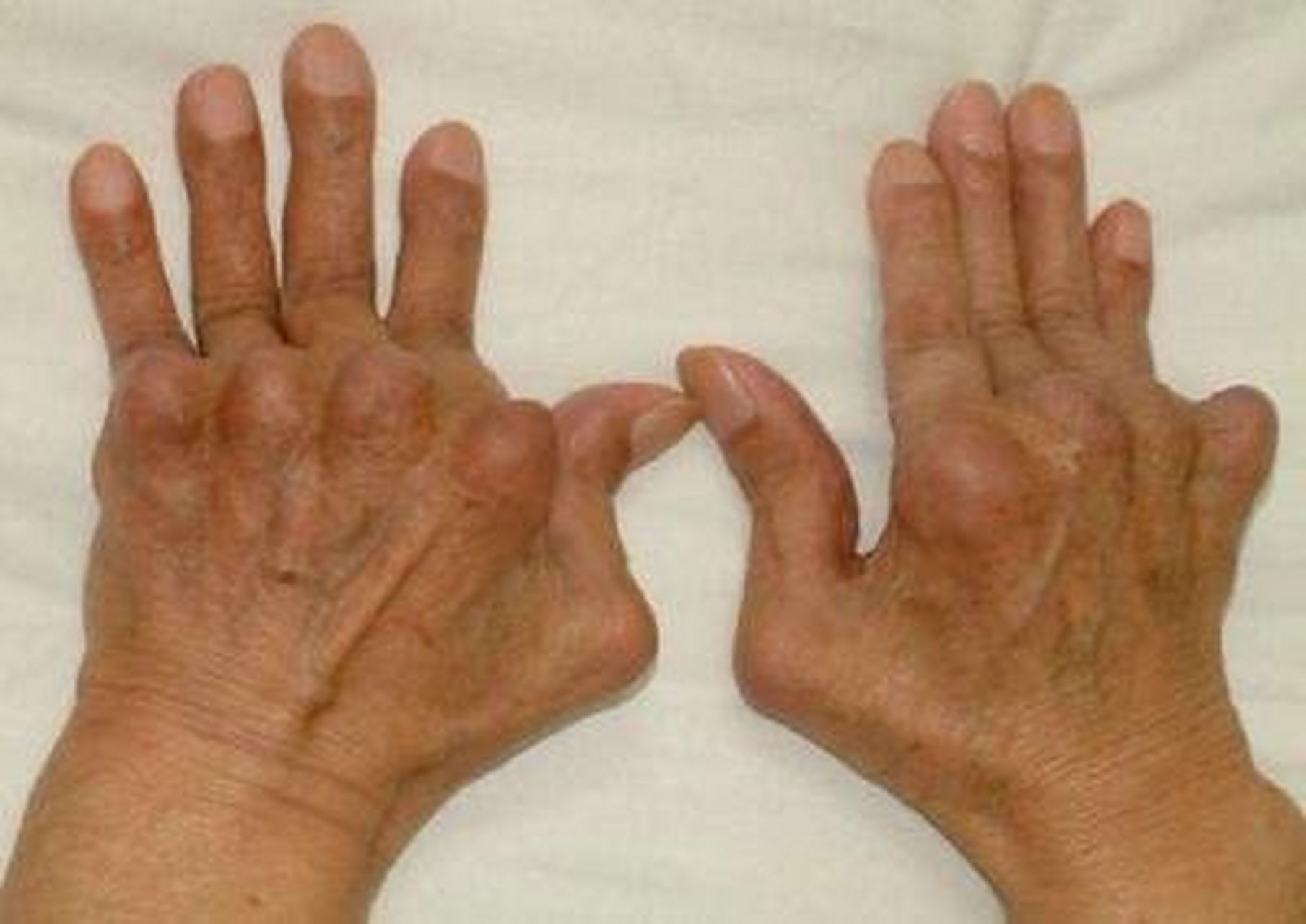 你是不以为手指关节出现轻度变形就是类风湿呢?